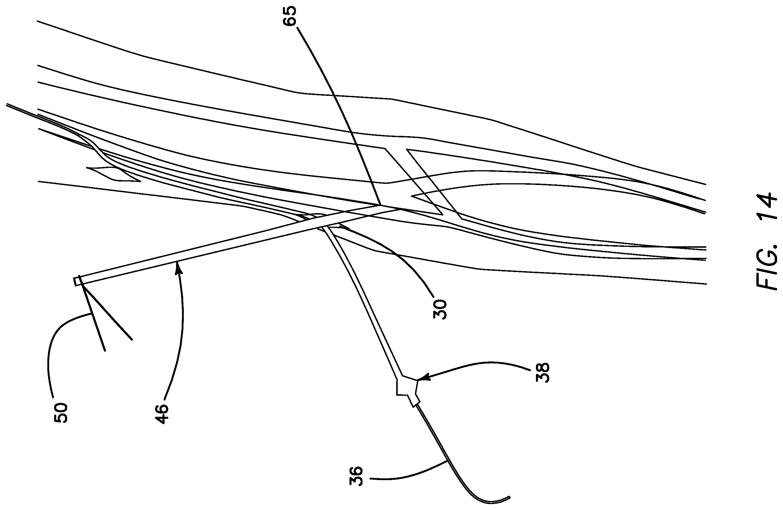 Patent US11793623 Figure 13 – Systems and methods for percutaneously placing biologic grafts at a procedural site