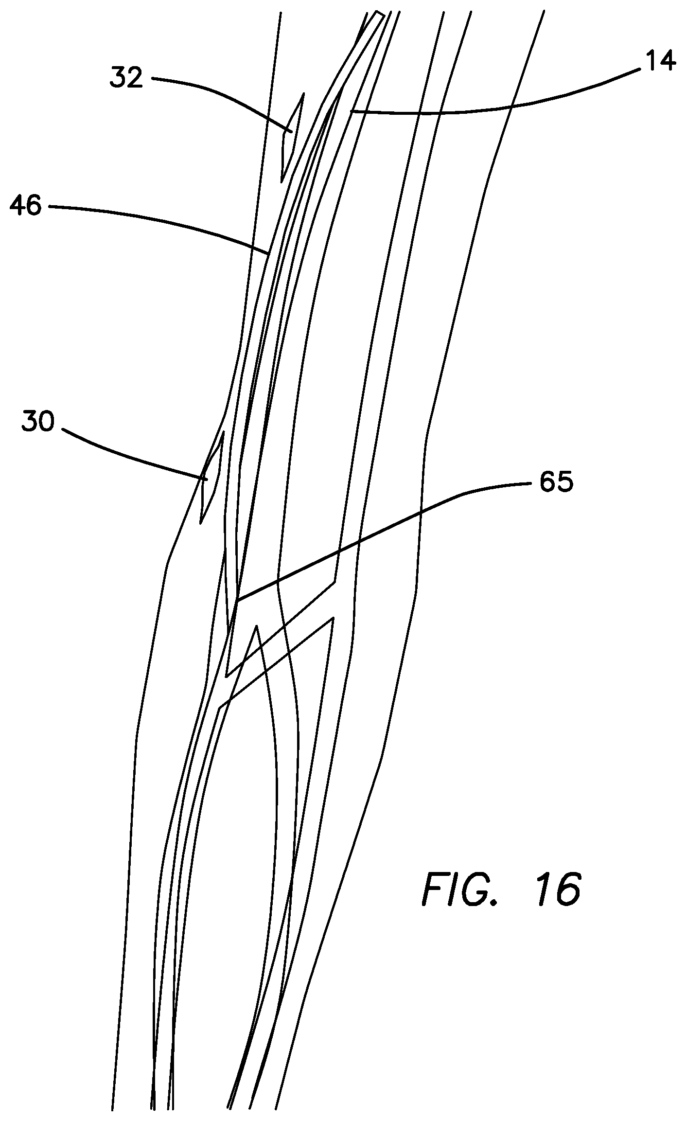 Patent US11793623 Figure 14 – Systems and methods for percutaneously placing biologic grafts at a procedural site
