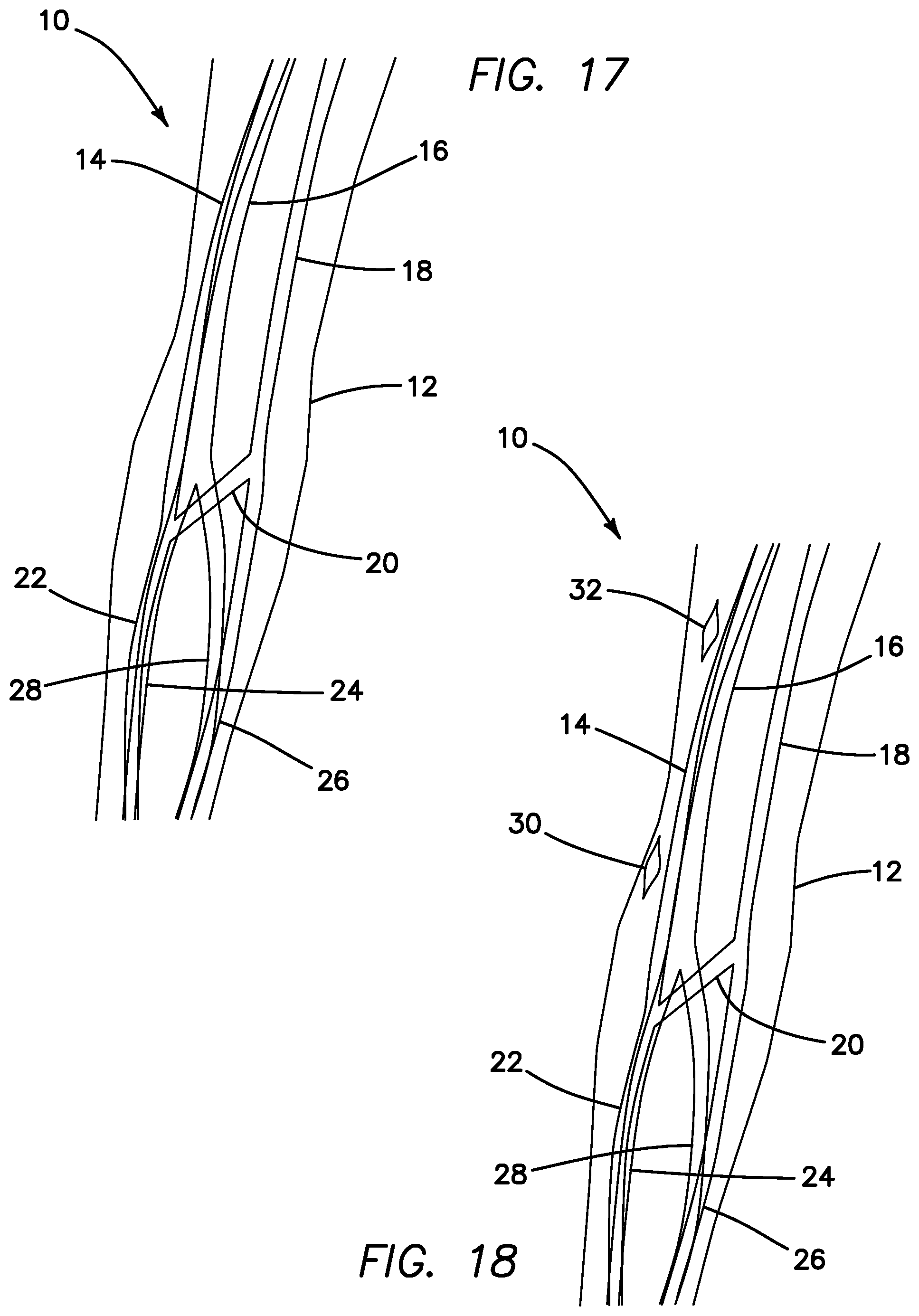 Patent US11793623 Figure 15 – Systems and methods for percutaneously placing biologic grafts at a procedural site