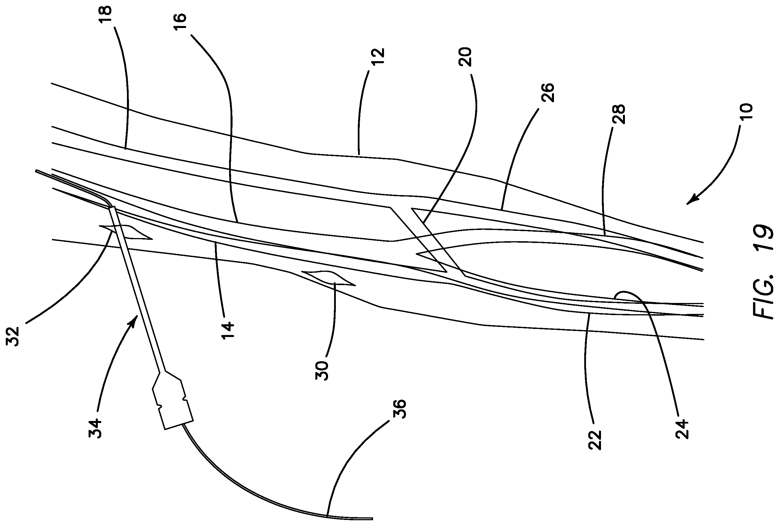 Patent US11793623 Figure 16 – Systems and methods for percutaneously placing biologic grafts at a procedural site