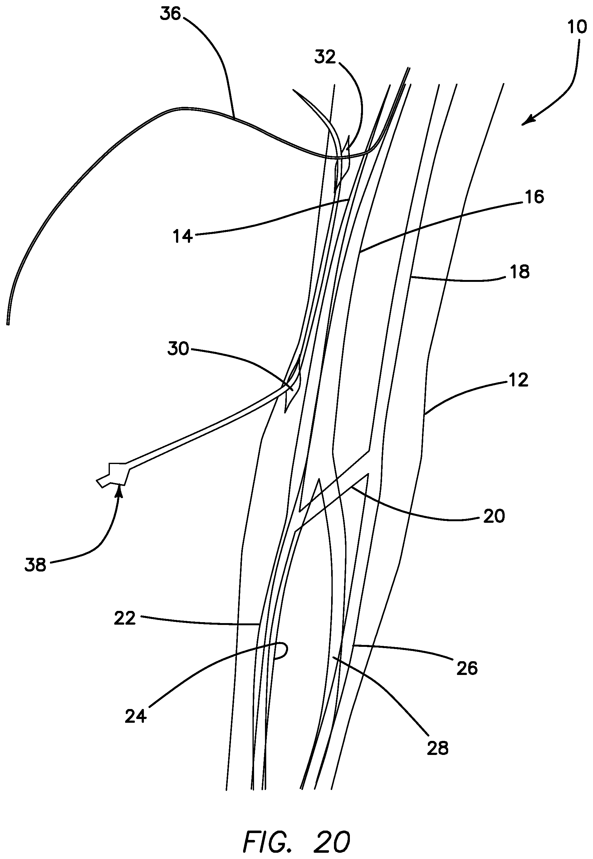 Patent US11793623 Figure 17 – Systems and methods for percutaneously placing biologic grafts at a procedural site