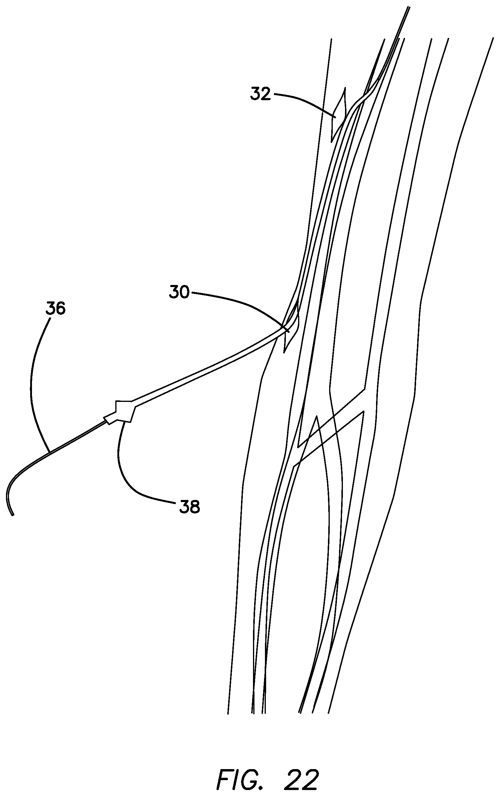 Patent US11793623 Figure 19 – Systems and methods for percutaneously placing biologic grafts at a procedural site
