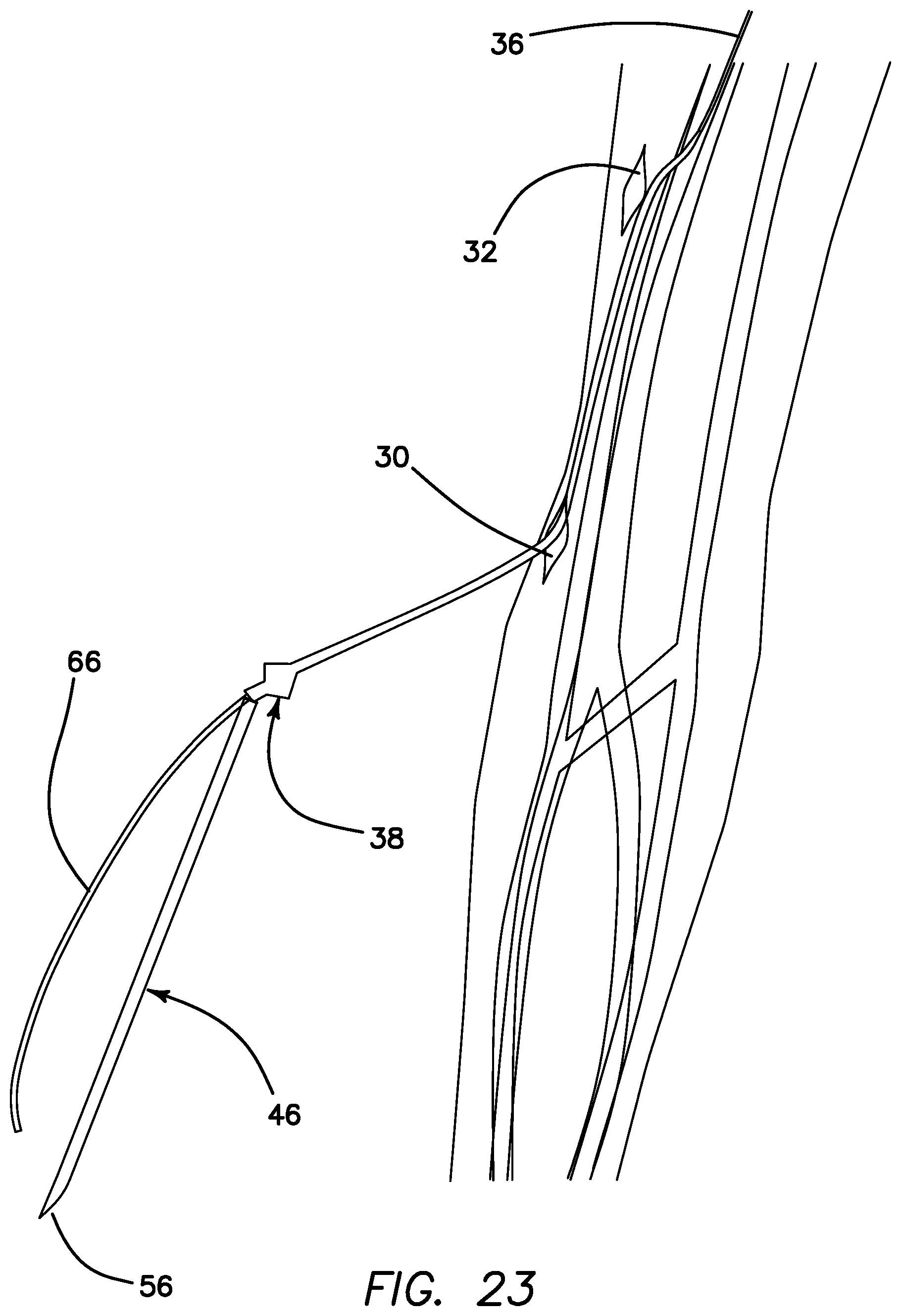 Patent US11793623 Figure 20 – Systems and methods for percutaneously placing biologic grafts at a procedural site