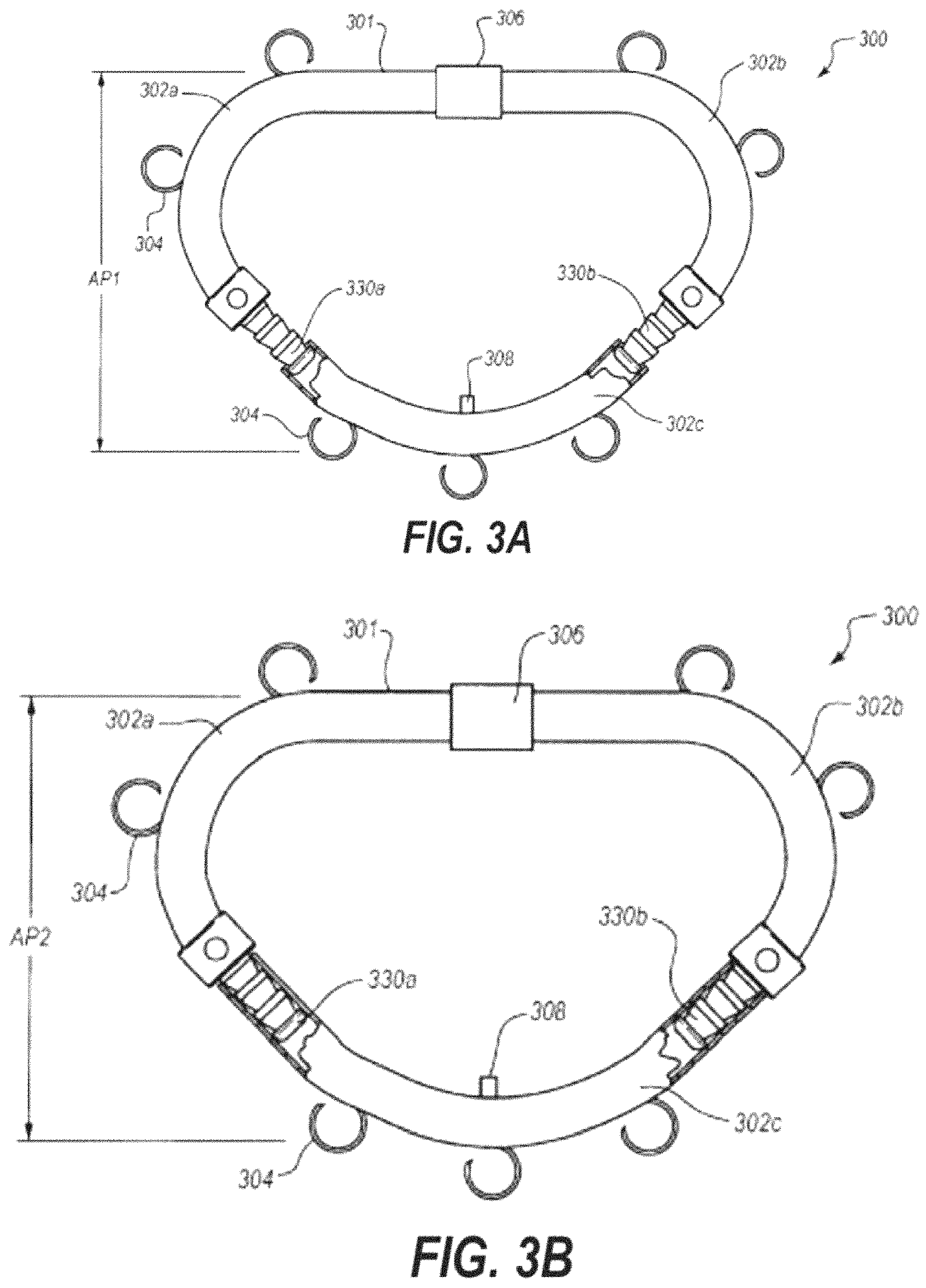 Patent US11793628 Figure 4 – Transcatheter bio-prosthesis member and support structure