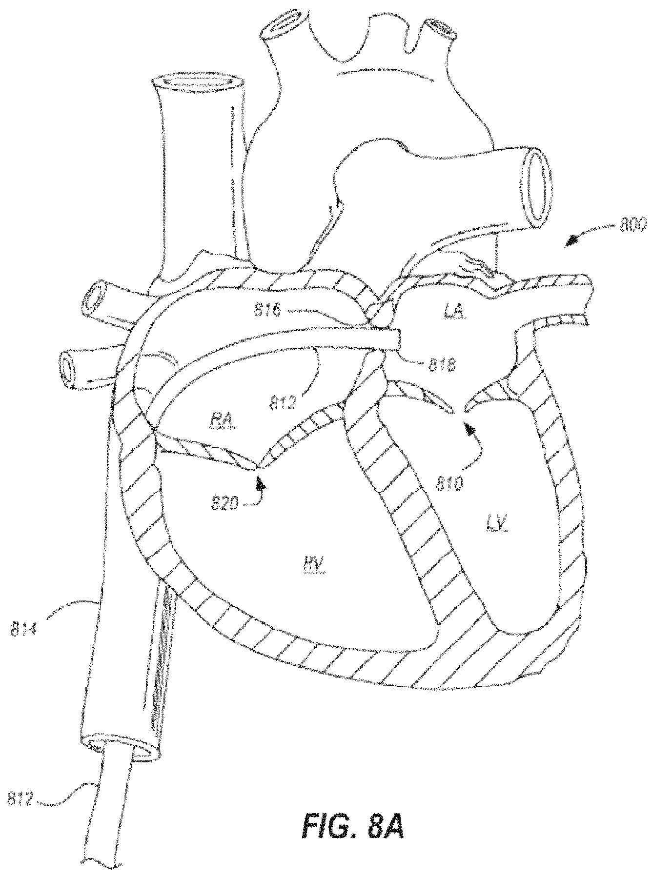 Patent US11793628 Figure 11 – Transcatheter bio-prosthesis member and support structure