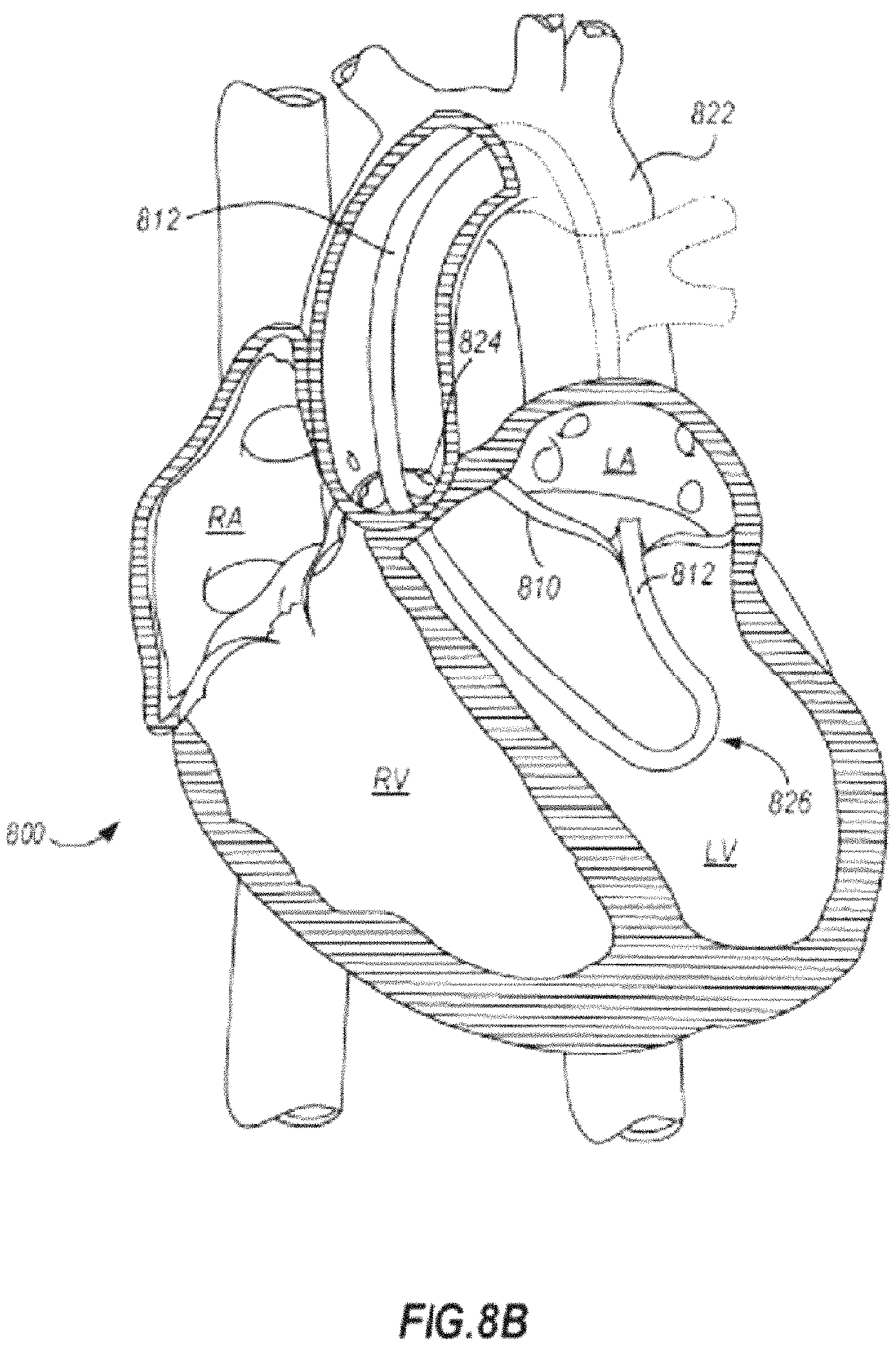 Patent US11793628 Figure 12 – Transcatheter bio-prosthesis member and support structure