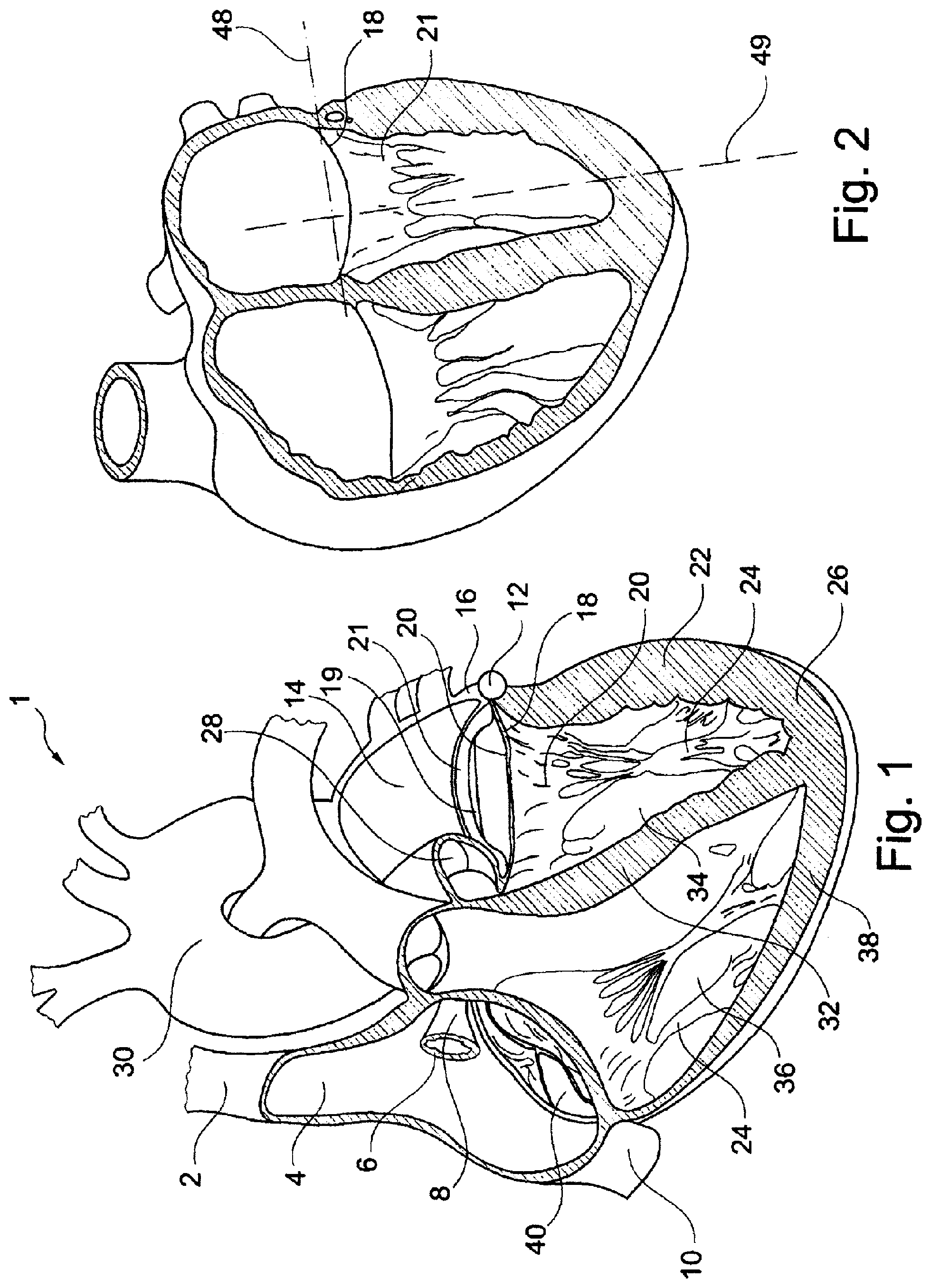 Patent US11793629 Figure 1 – Device and a method for augmenting heart function