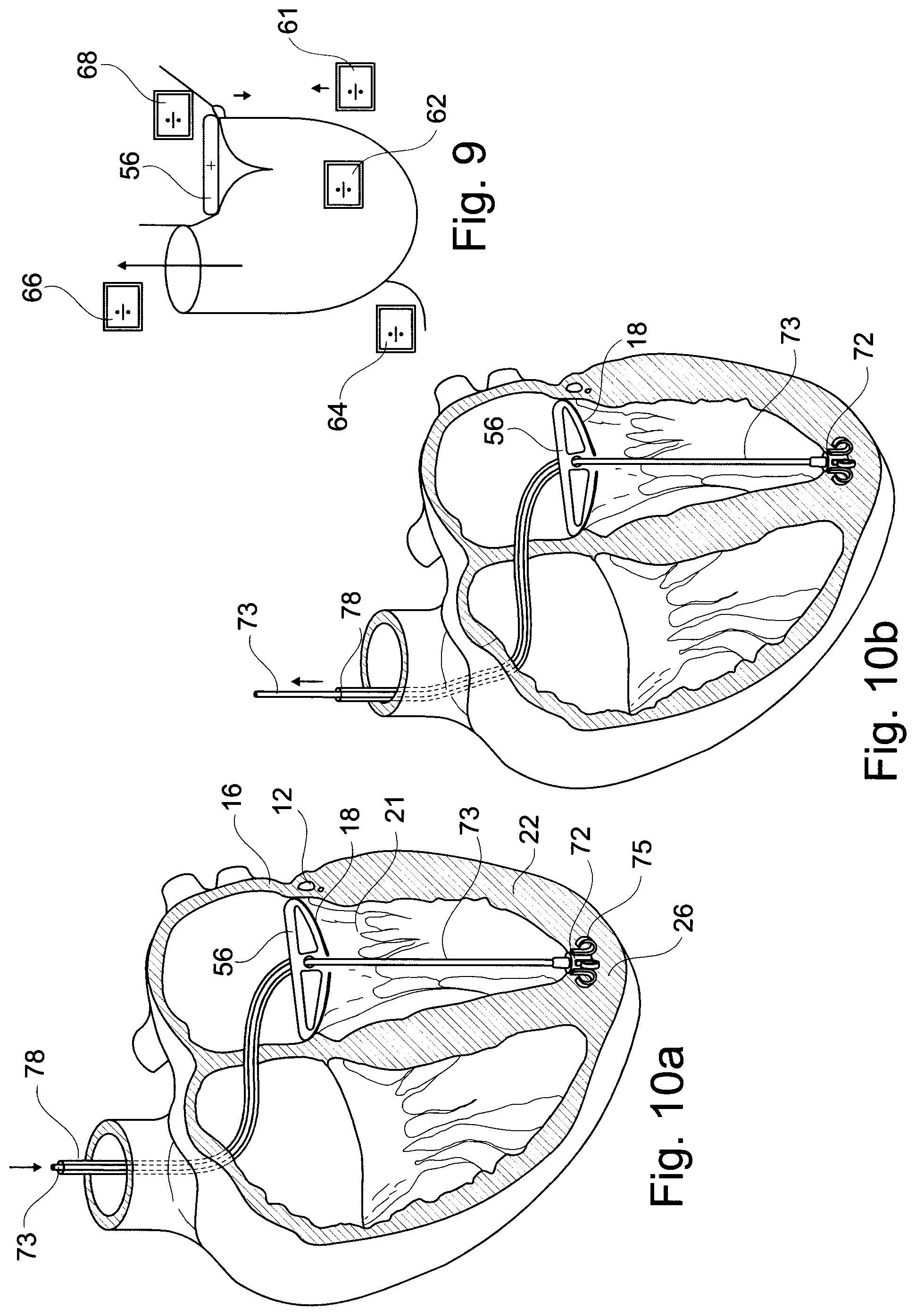 Patent US11793629 Figure 4 – Device and a method for augmenting heart function
