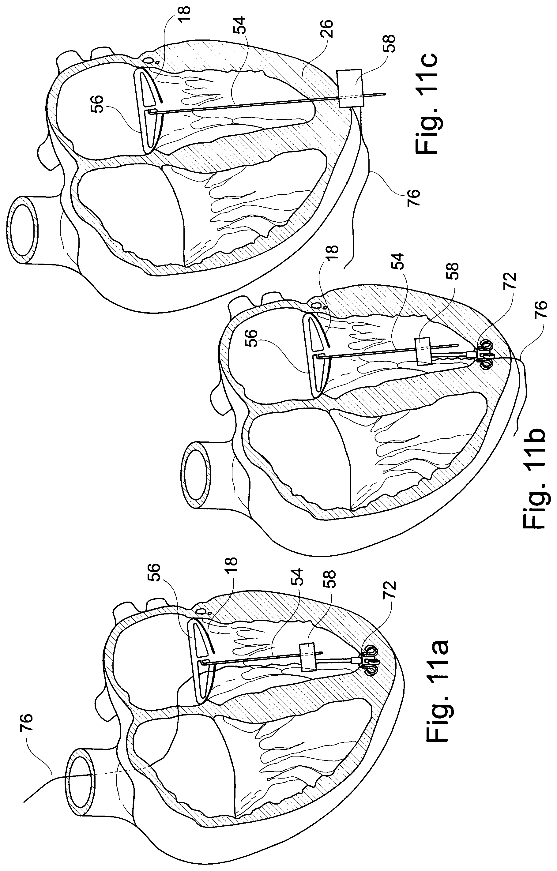 Patent US11793629 Figure 5 – Device and a method for augmenting heart function