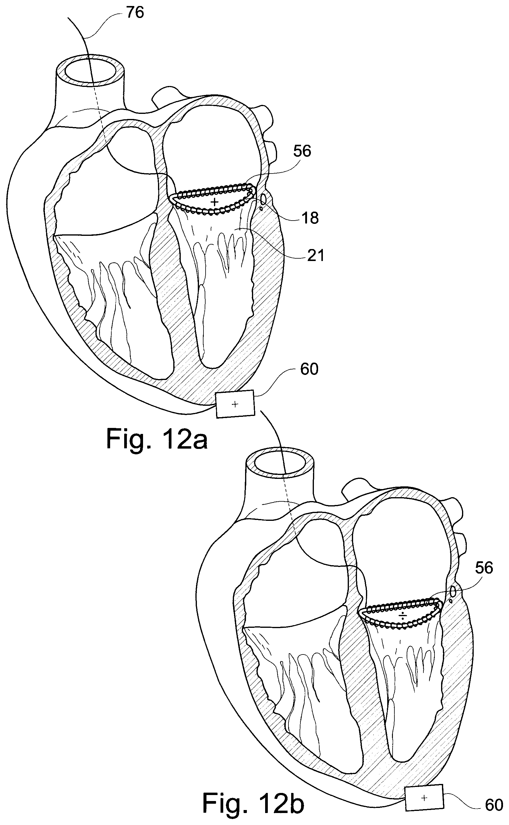 Patent US11793629 Figure 6 – Device and a method for augmenting heart function