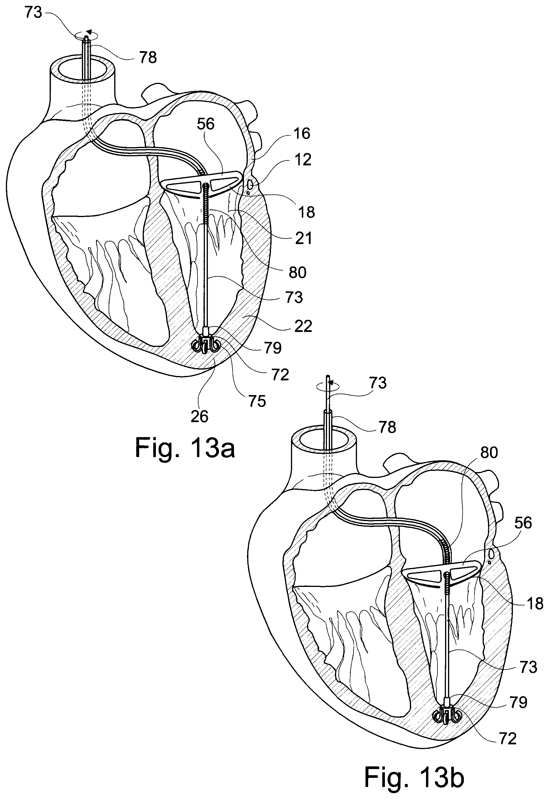 Patent US11793629 Figure 7 – Device and a method for augmenting heart function
