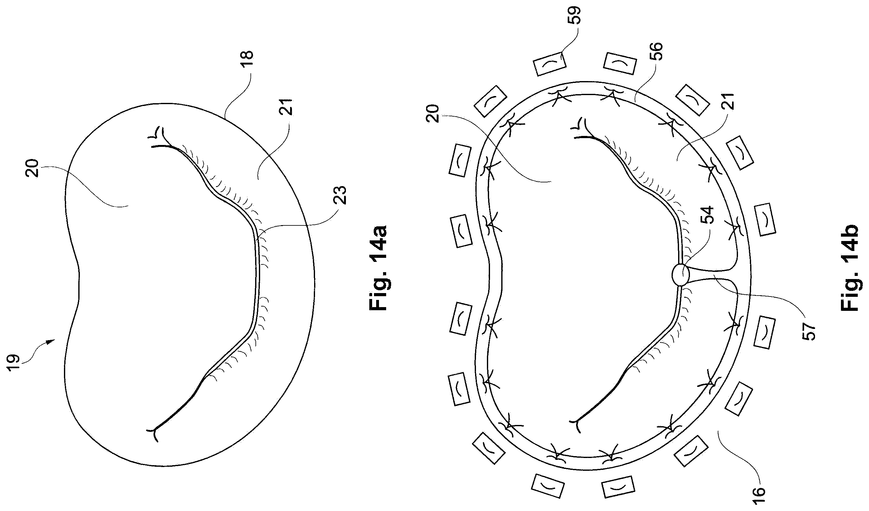 Patent US11793629 Figure 8 – Device and a method for augmenting heart function