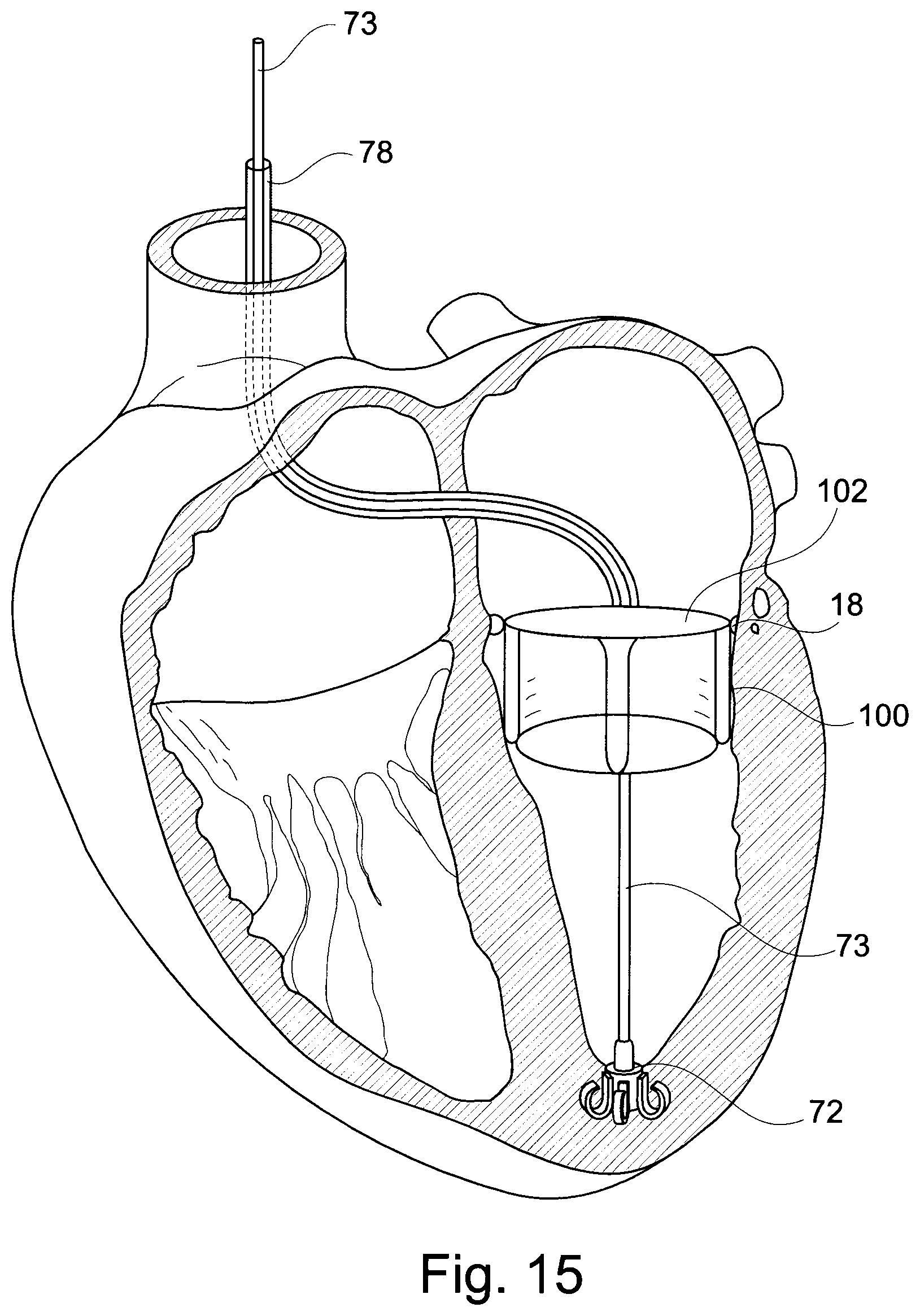 Patent US11793629 Figure 9 – Device and a method for augmenting heart function