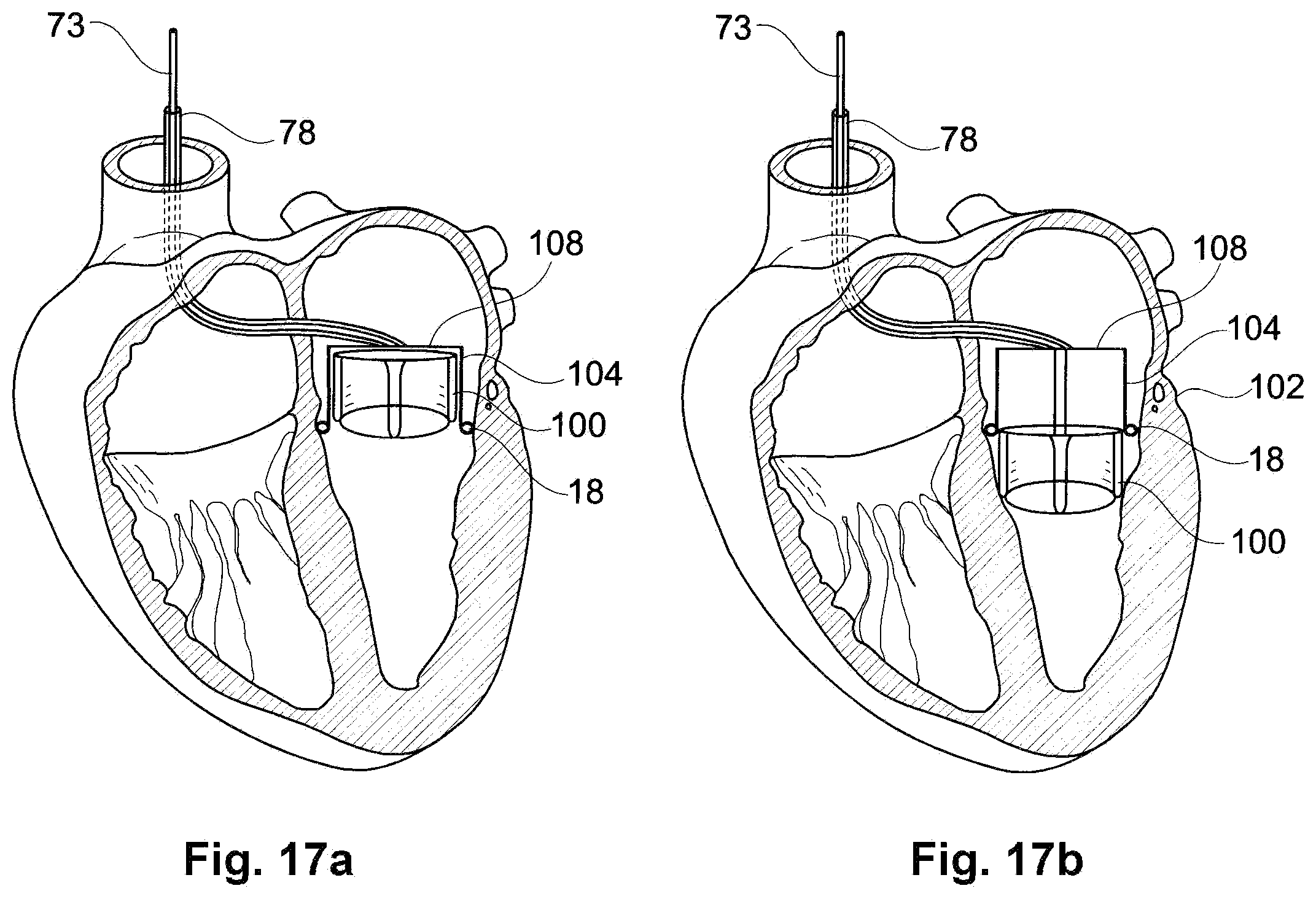 Patent US11793629 Figure 11 – Device and a method for augmenting heart function