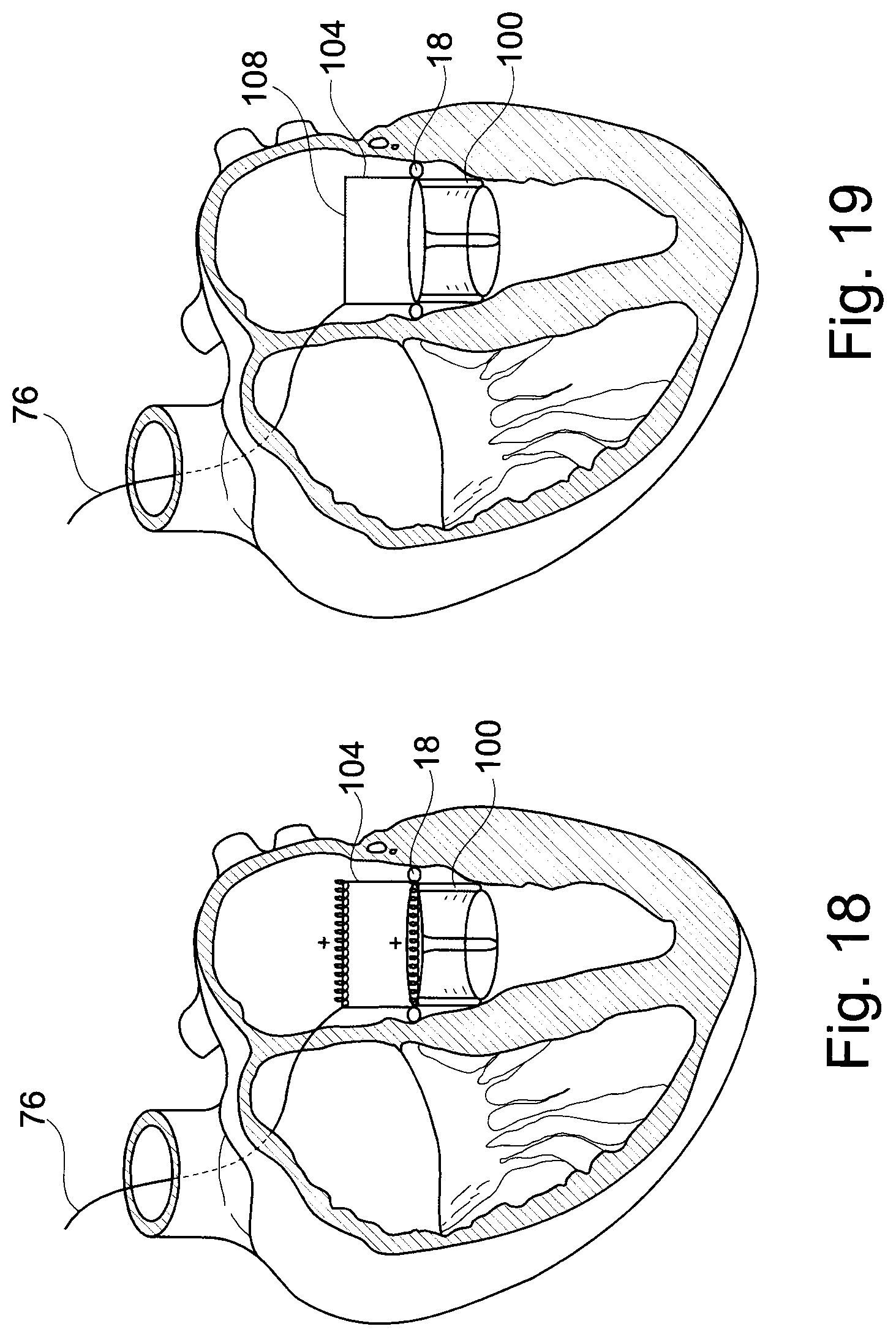 Patent US11793629 Figure 12 – Device and a method for augmenting heart function