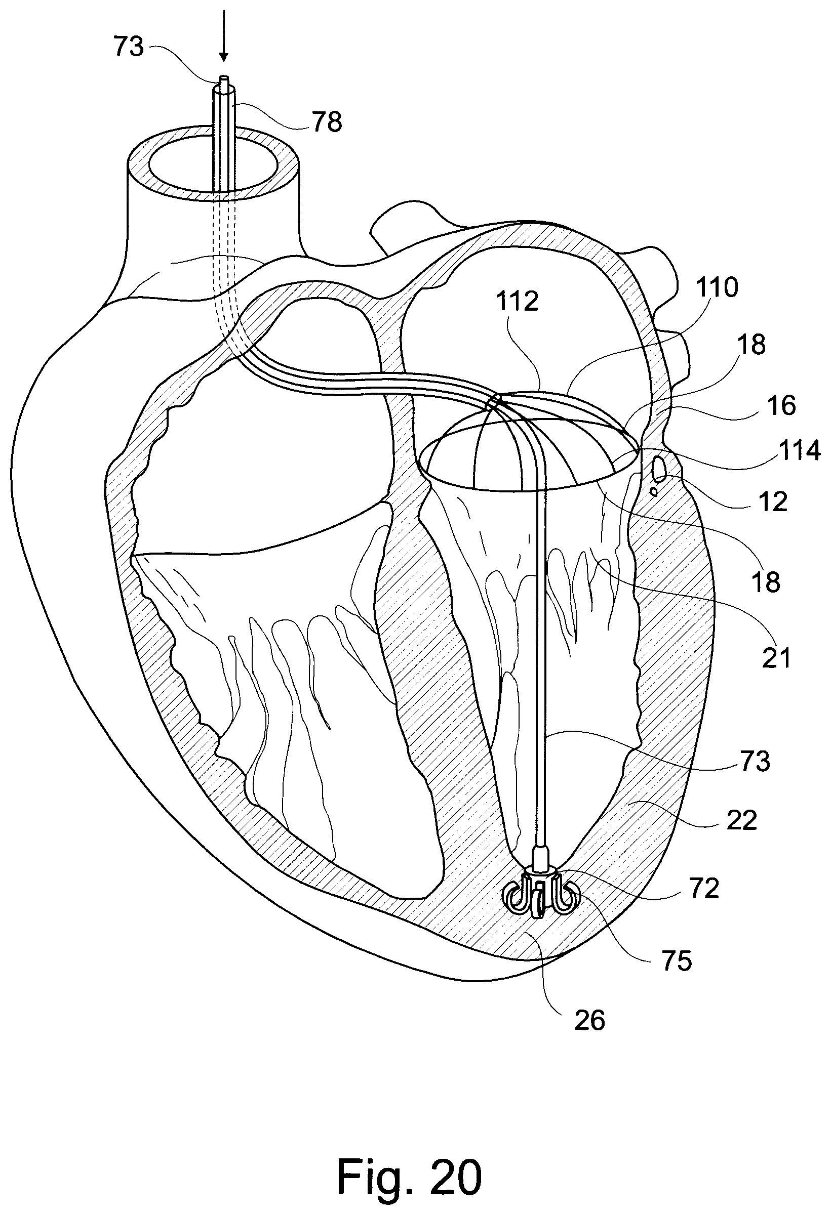 Patent US11793629 Figure 13 – Device and a method for augmenting heart function