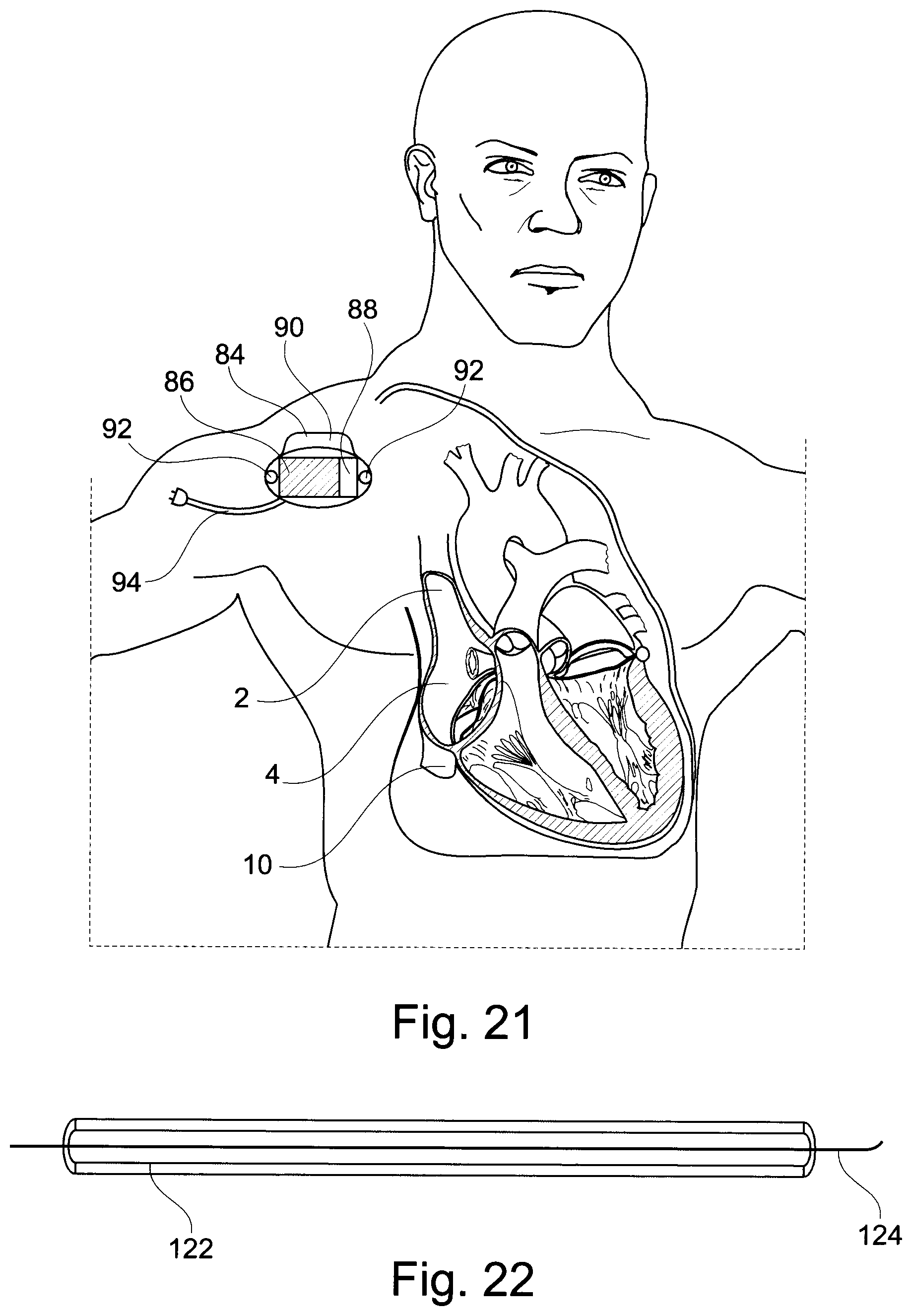 Patent US11793629 Figure 14 – Device and a method for augmenting heart function