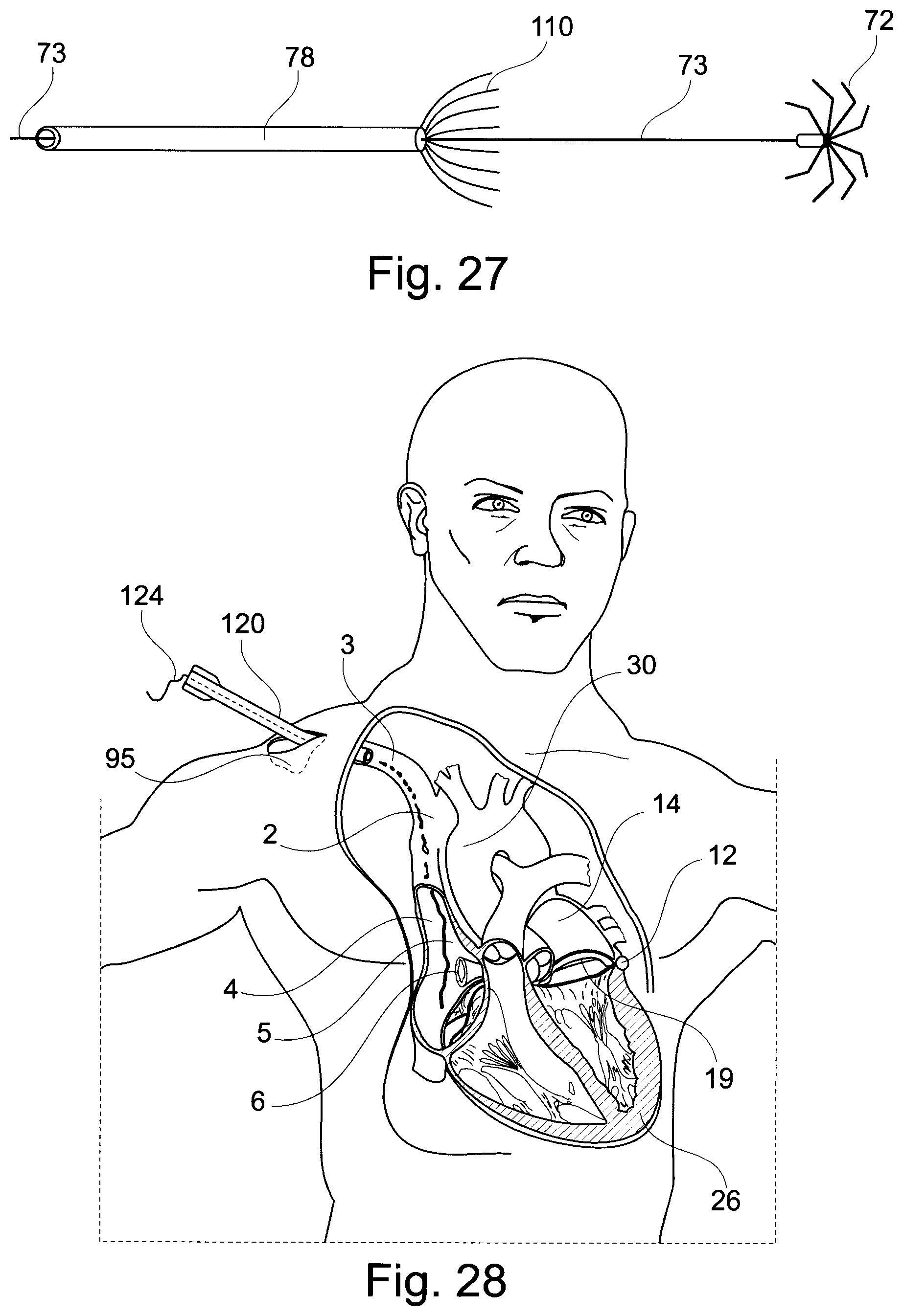 Patent US11793629 Figure 17 – Device and a method for augmenting heart function
