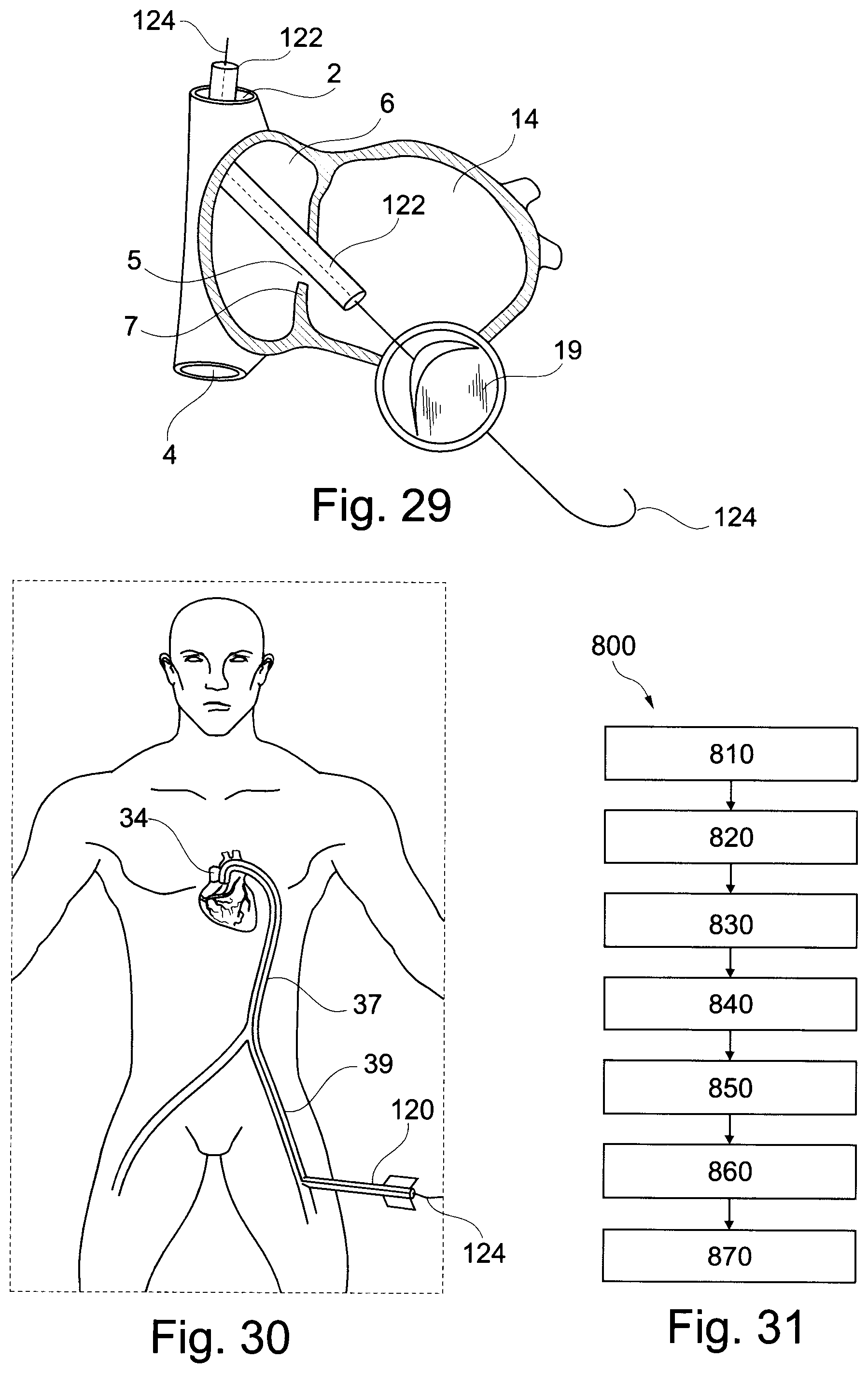 Patent US11793629 Figure 18 – Device and a method for augmenting heart function