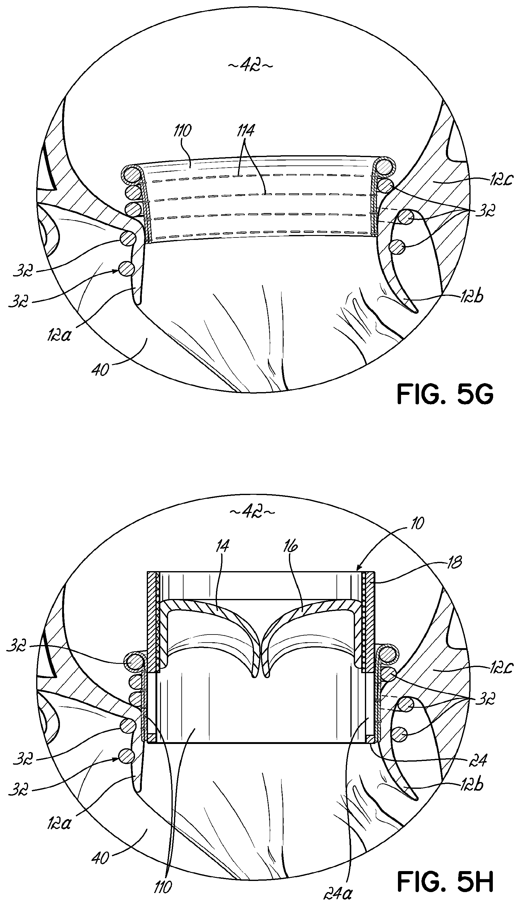 Patent US11793630 Figure 11 – Apparatus and methods for implanting a replacement heart valve