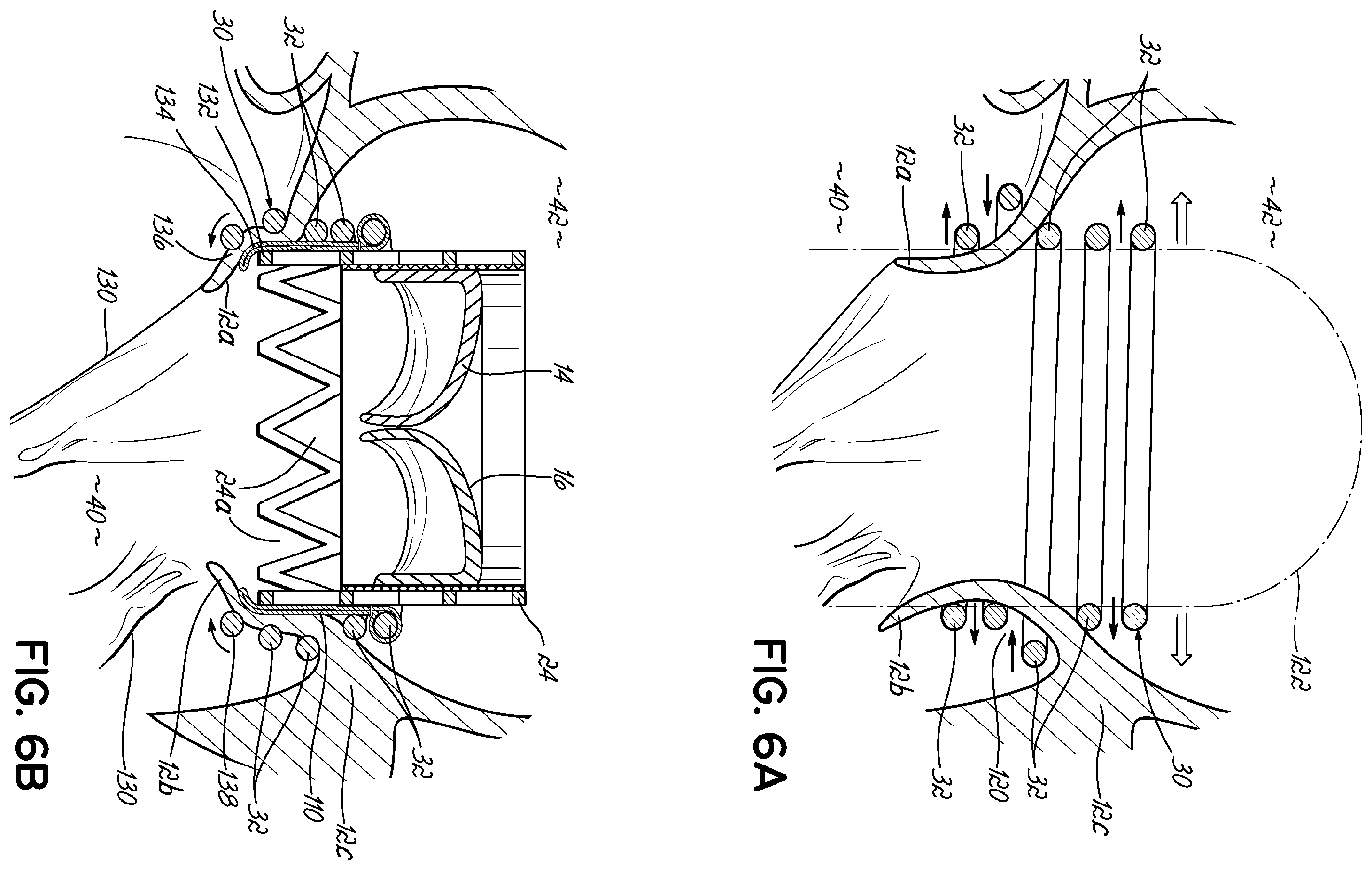 Patent US11793630 Figure 12 – Apparatus and methods for implanting a replacement heart valve