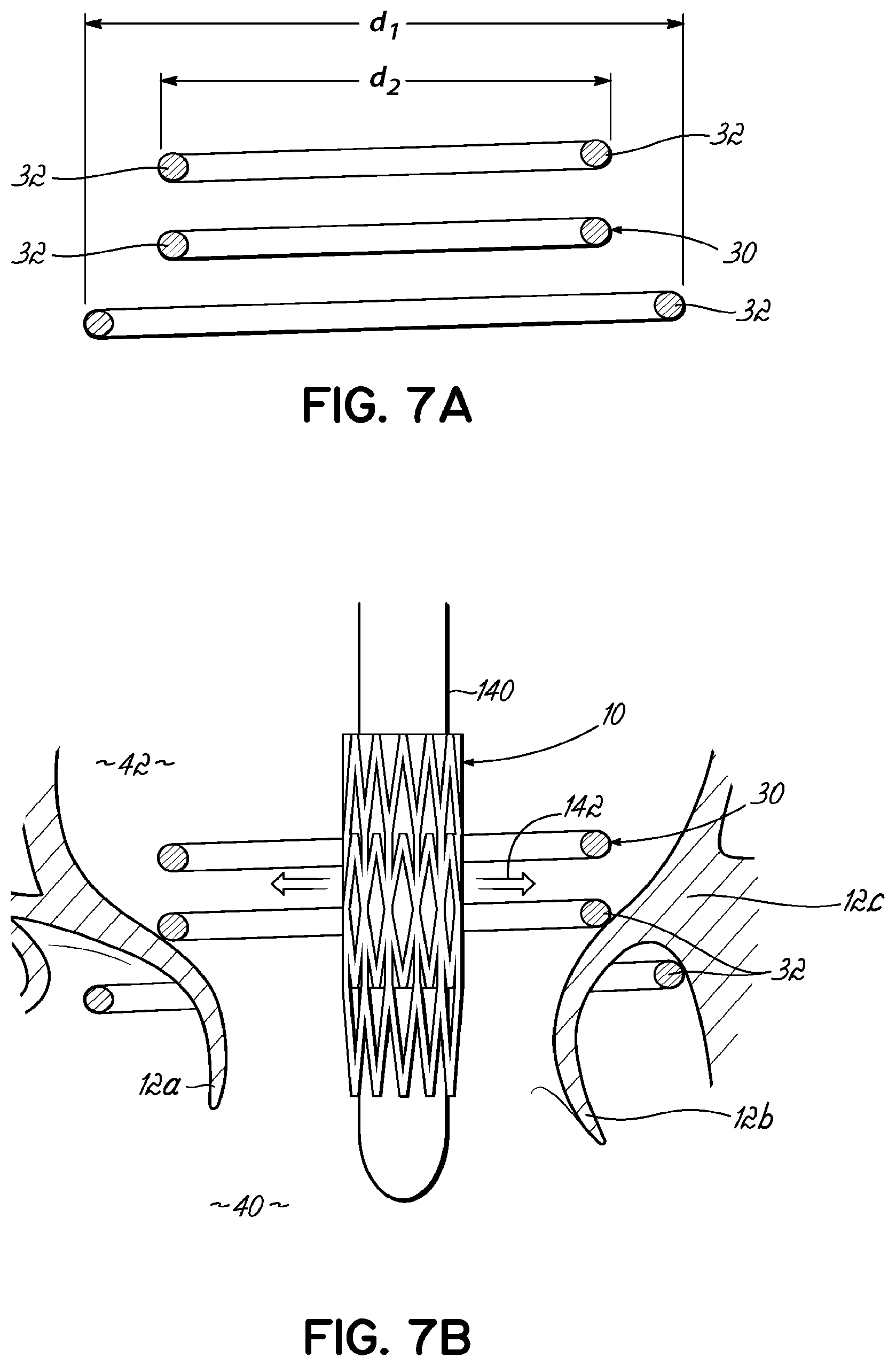 Patent US11793630 Figure 13 – Apparatus and methods for implanting a replacement heart valve
