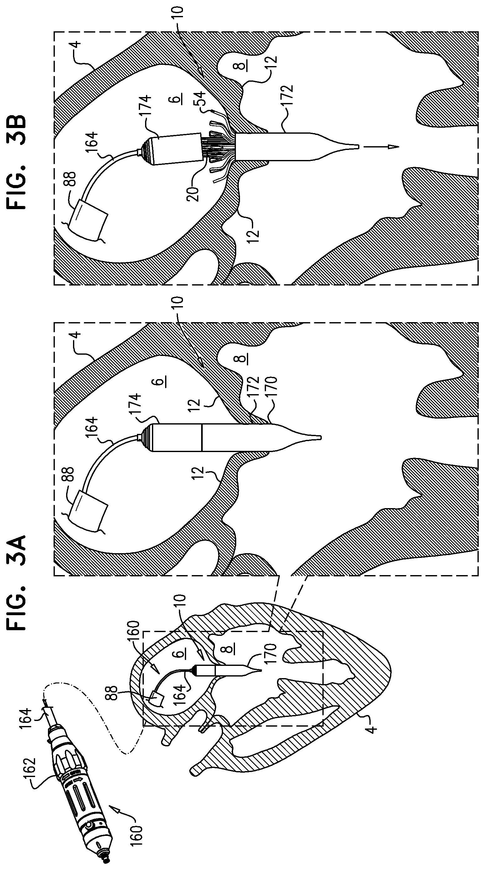 Patent US11793633 Figure 5 – Prosthetic heart valve