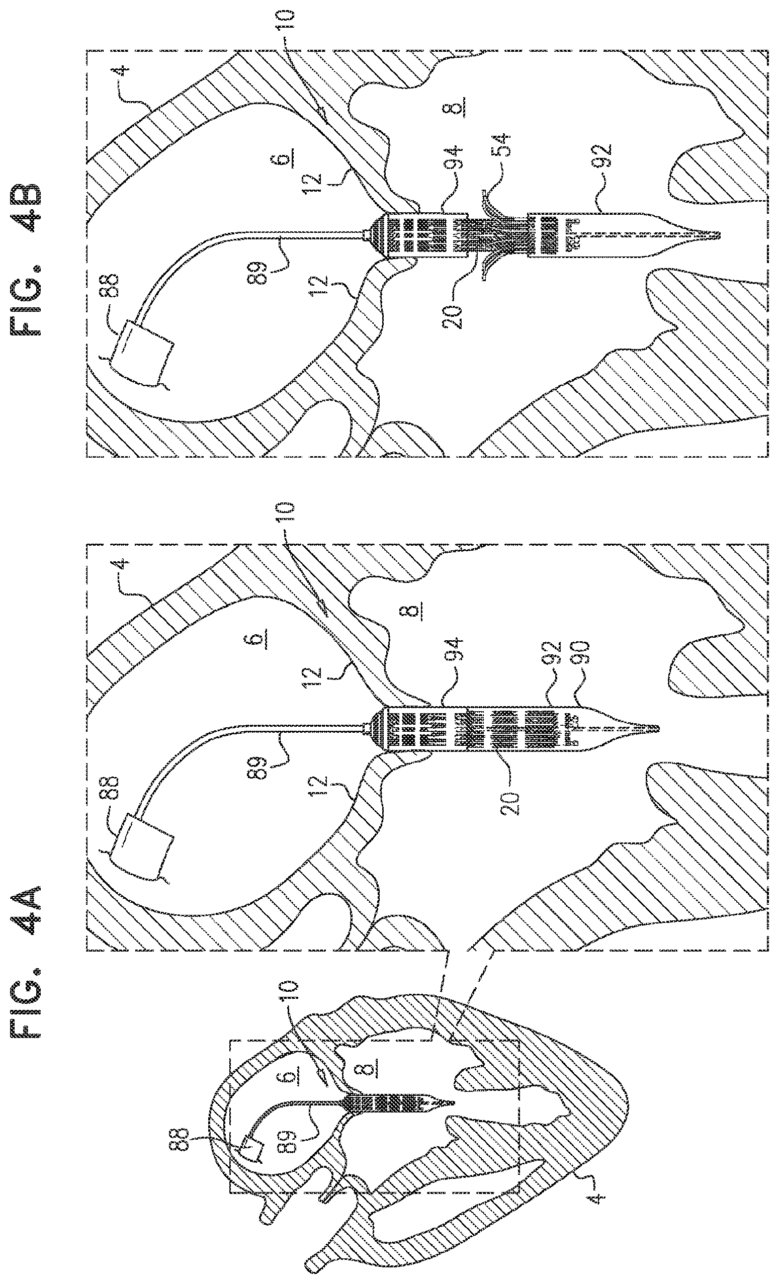 Patent US11793635 Figure 7 – Prosthetic valve with angularly offset frames