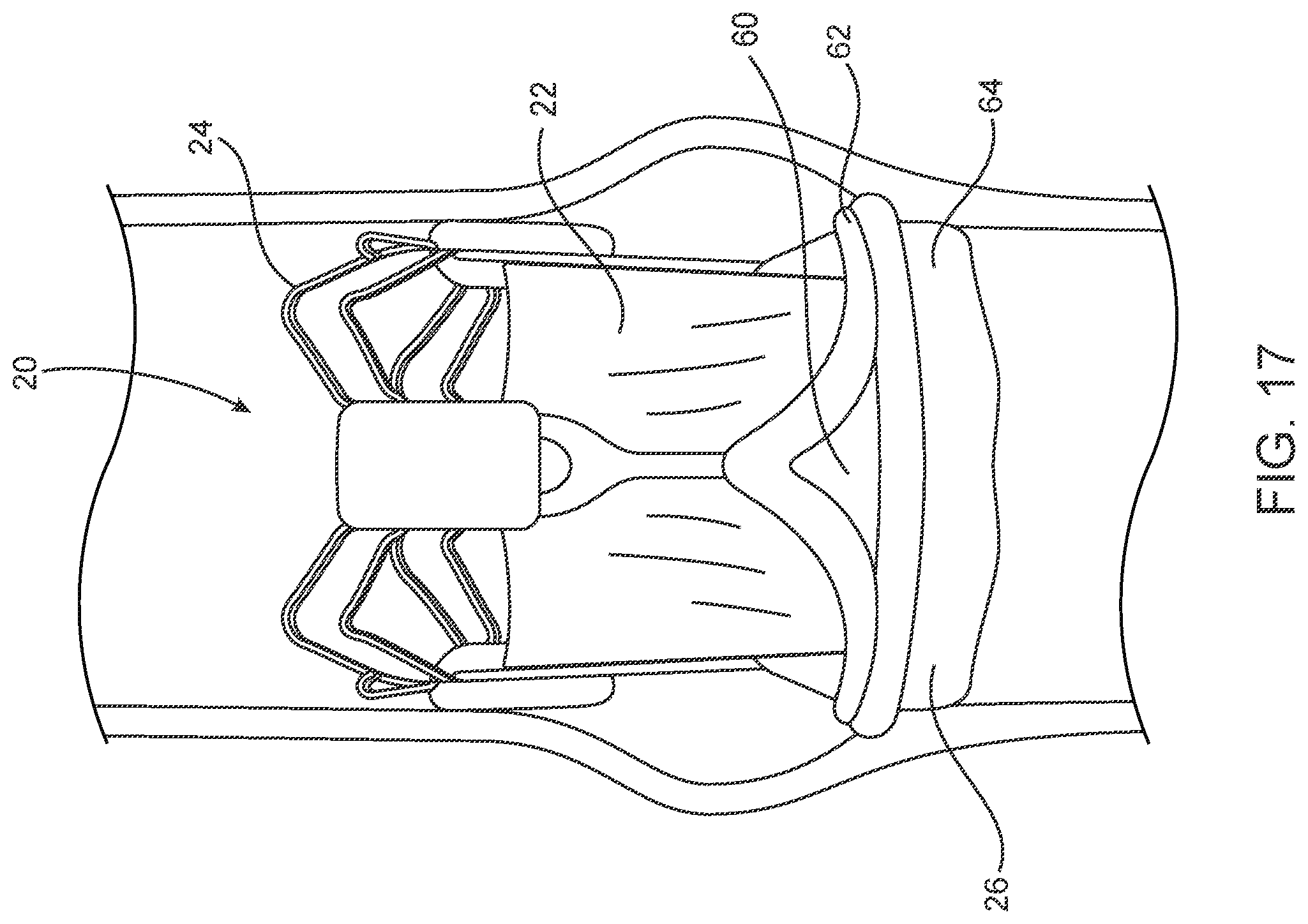 Patent US11793637 Figure 13 – Valve delivery tool