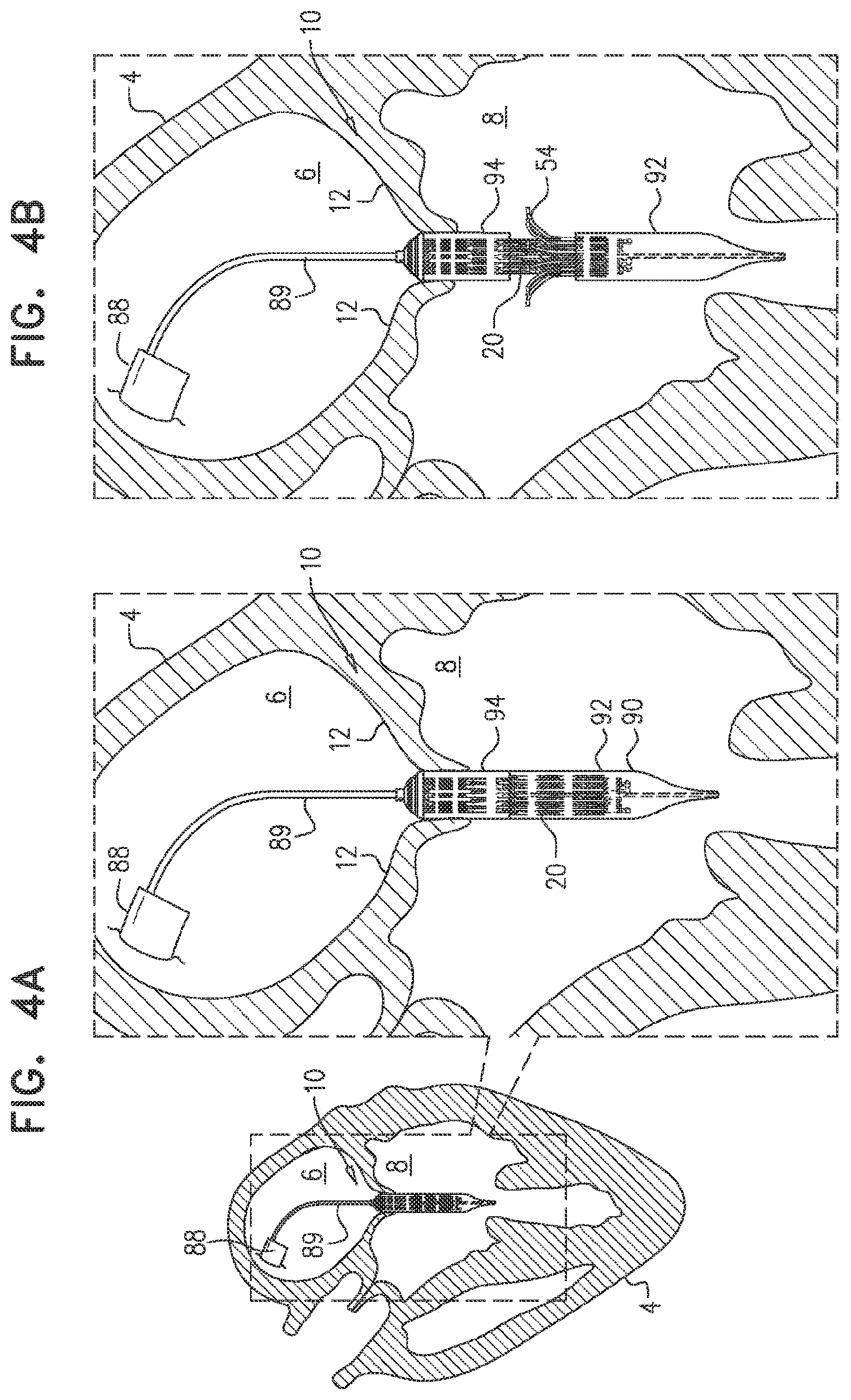 Patent US11793638 Figure 7 – Prosthetic valve with pivoting tissue anchor portions
