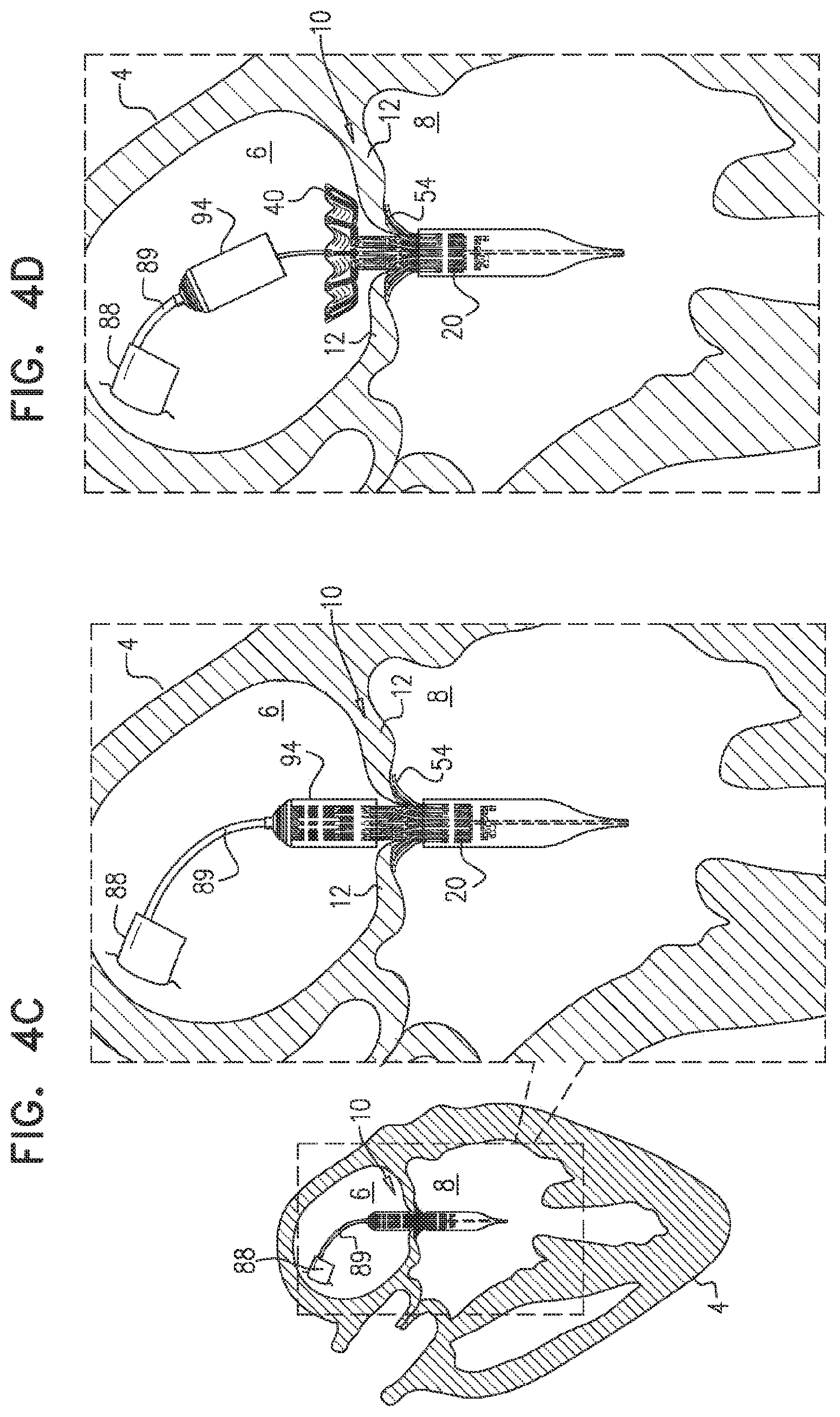 Patent US11793638 Figure 8 – Prosthetic valve with pivoting tissue anchor portions