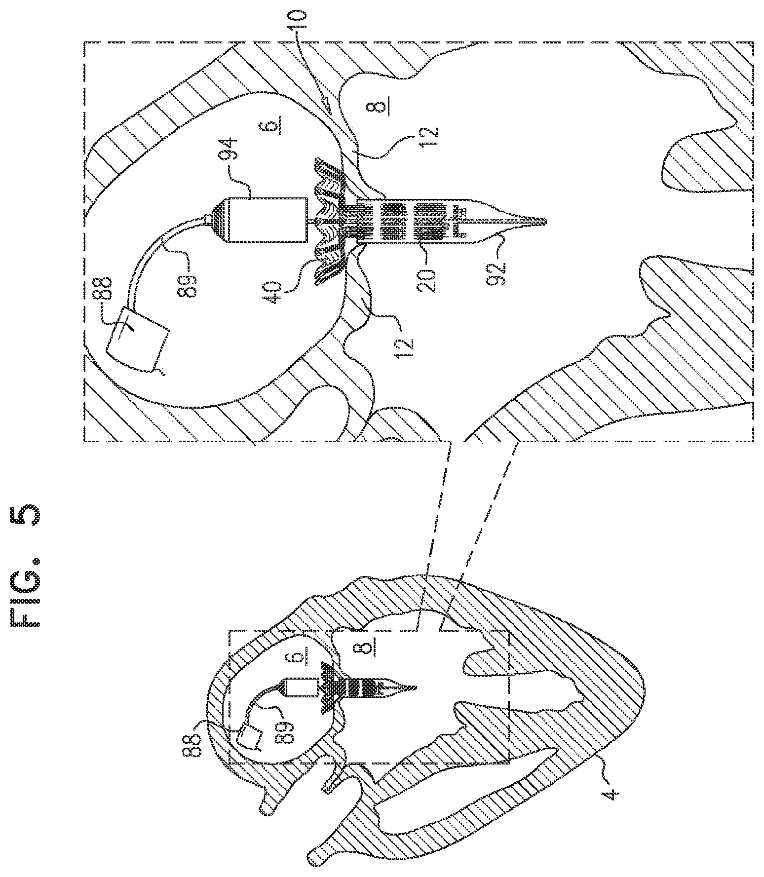 Patent US11793638 Figure 10 – Prosthetic valve with pivoting tissue anchor portions