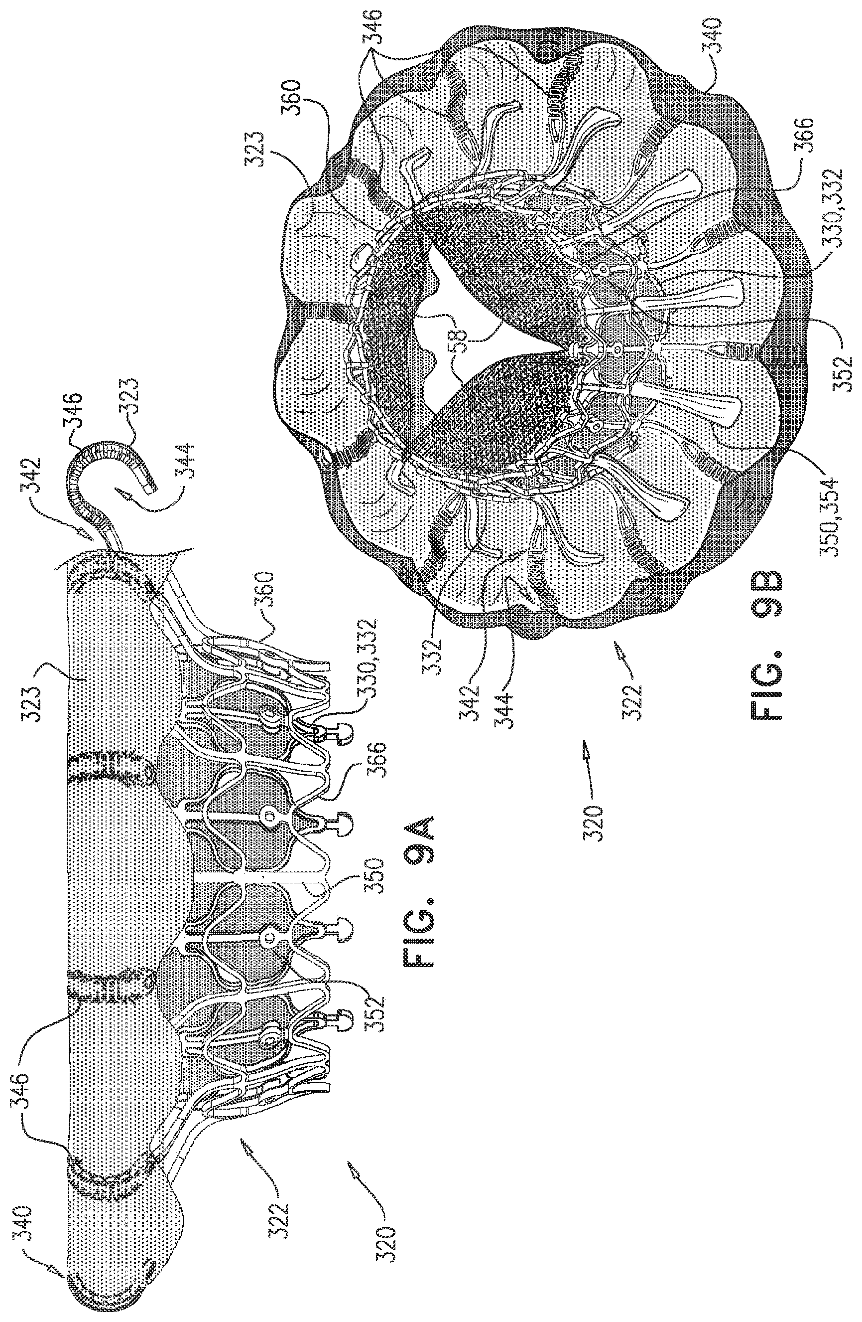 Patent US11793638 Figure 14 – Prosthetic valve with pivoting tissue anchor portions
