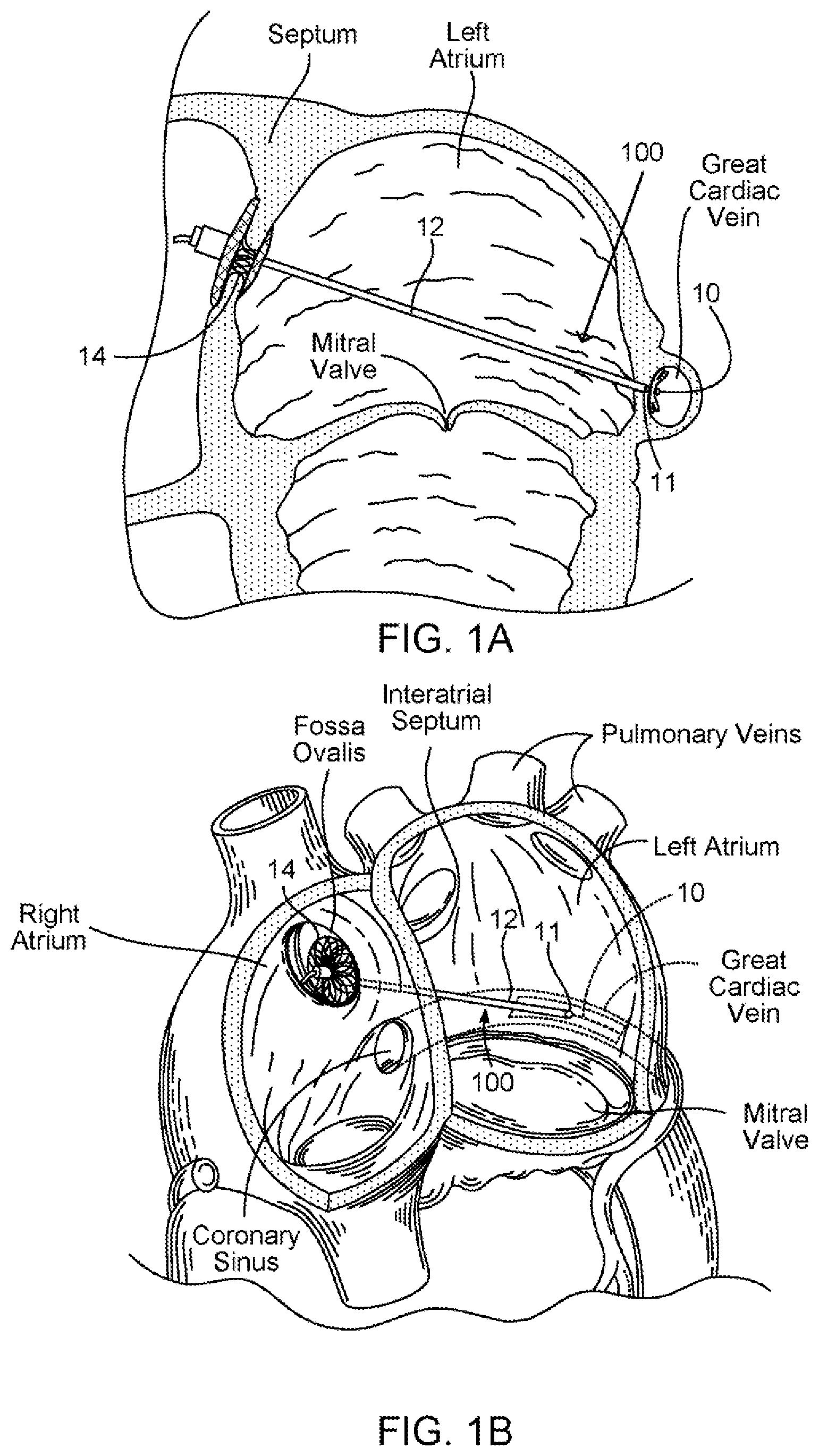 Patent US11793639 Figure 1 – Devices, systems and methods for reshaping a heart valve annulus