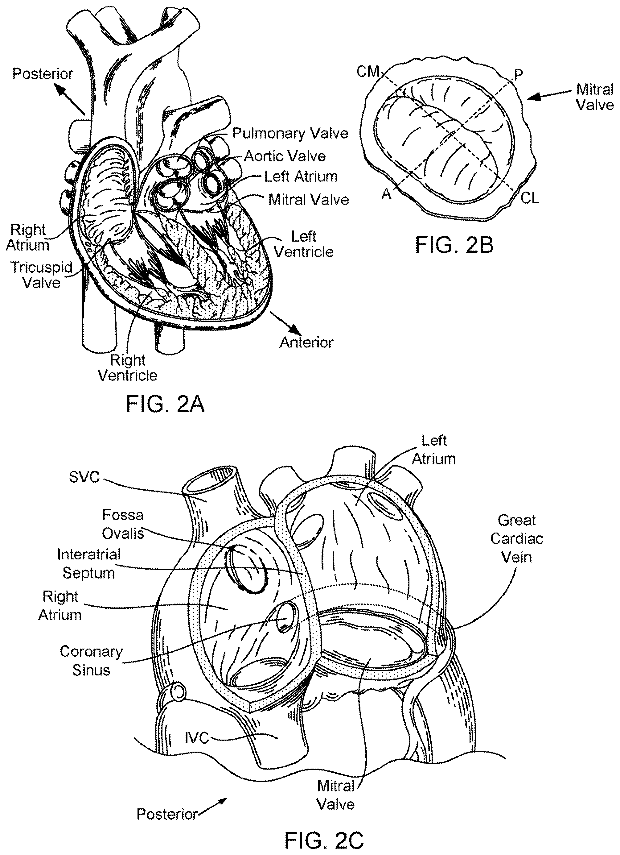 Patent US11793639 Figure 2 – Devices, systems and methods for reshaping a heart valve annulus