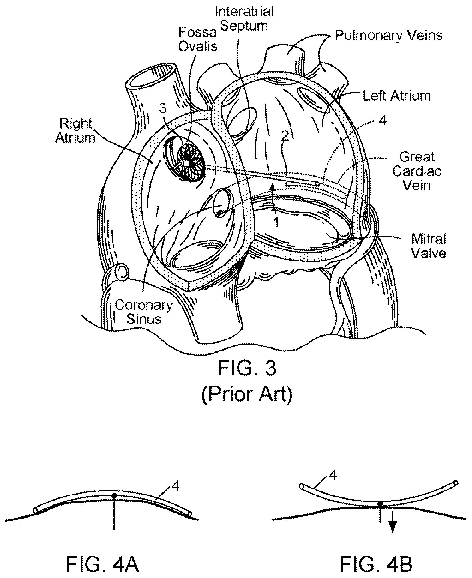 Patent US11793639 Figure 3 – Devices, systems and methods for reshaping a heart valve annulus