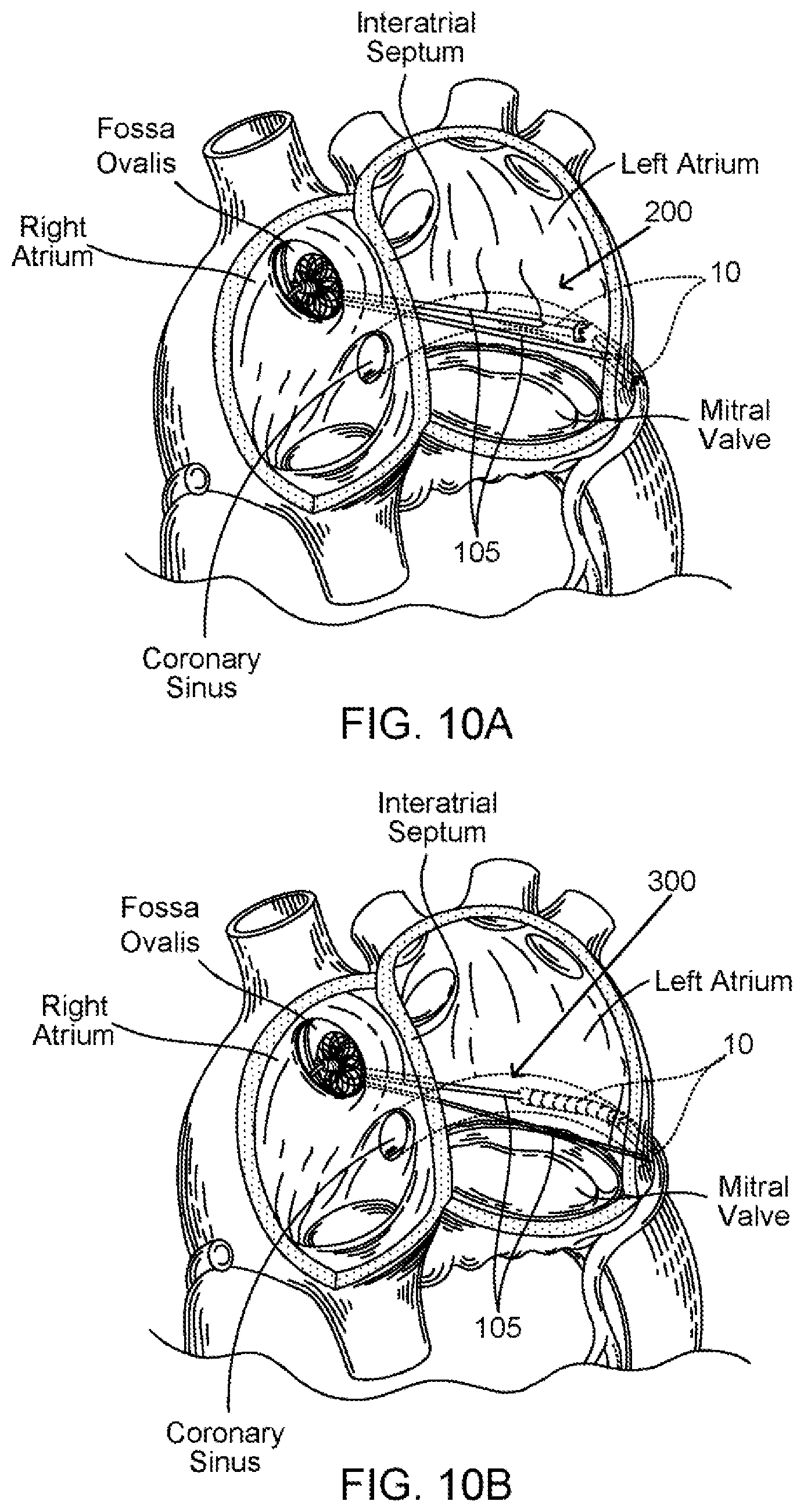 Patent US11793639 Figure 6 – Devices, systems and methods for reshaping a heart valve annulus