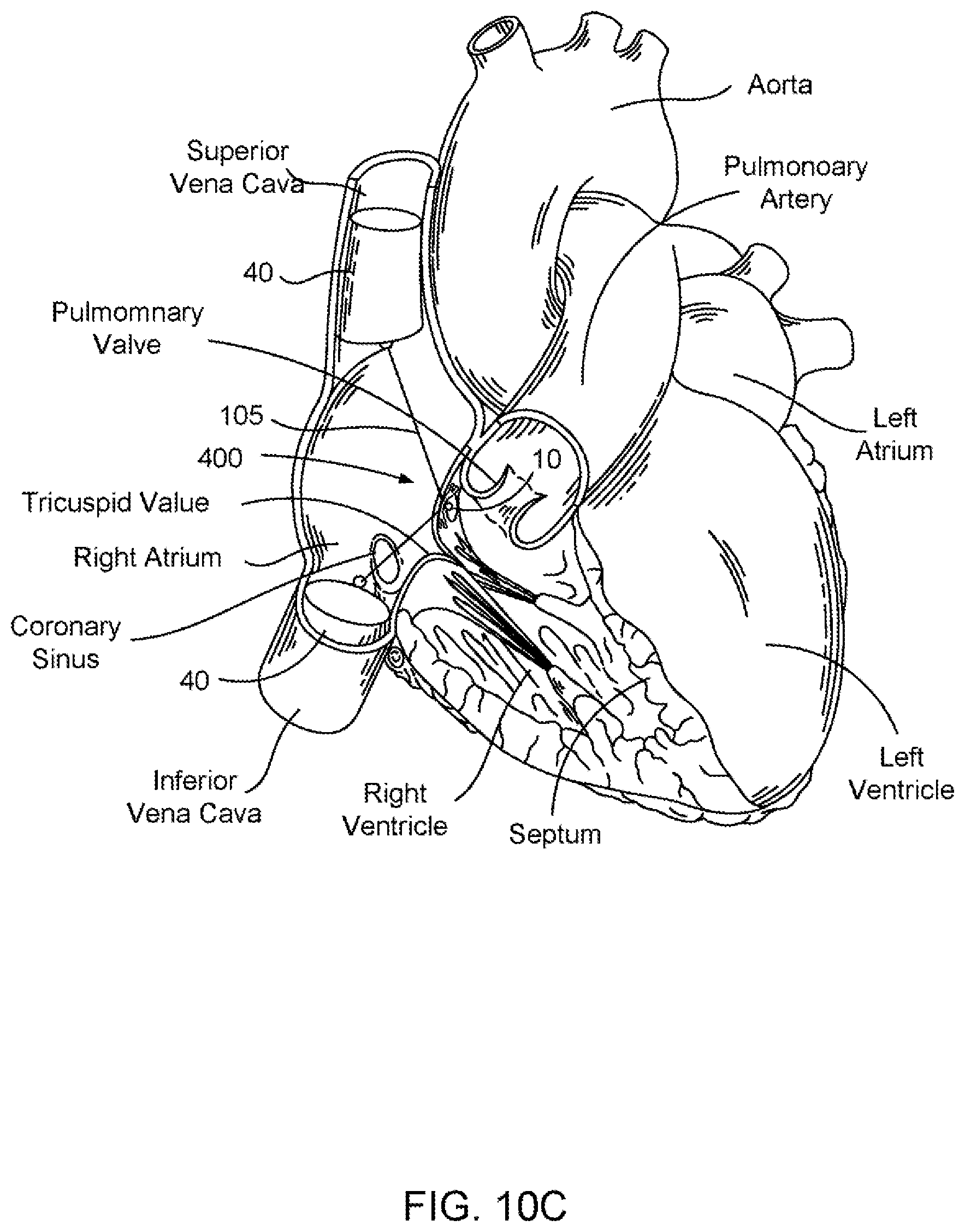 Patent US11793639 Figure 7 – Devices, systems and methods for reshaping a heart valve annulus