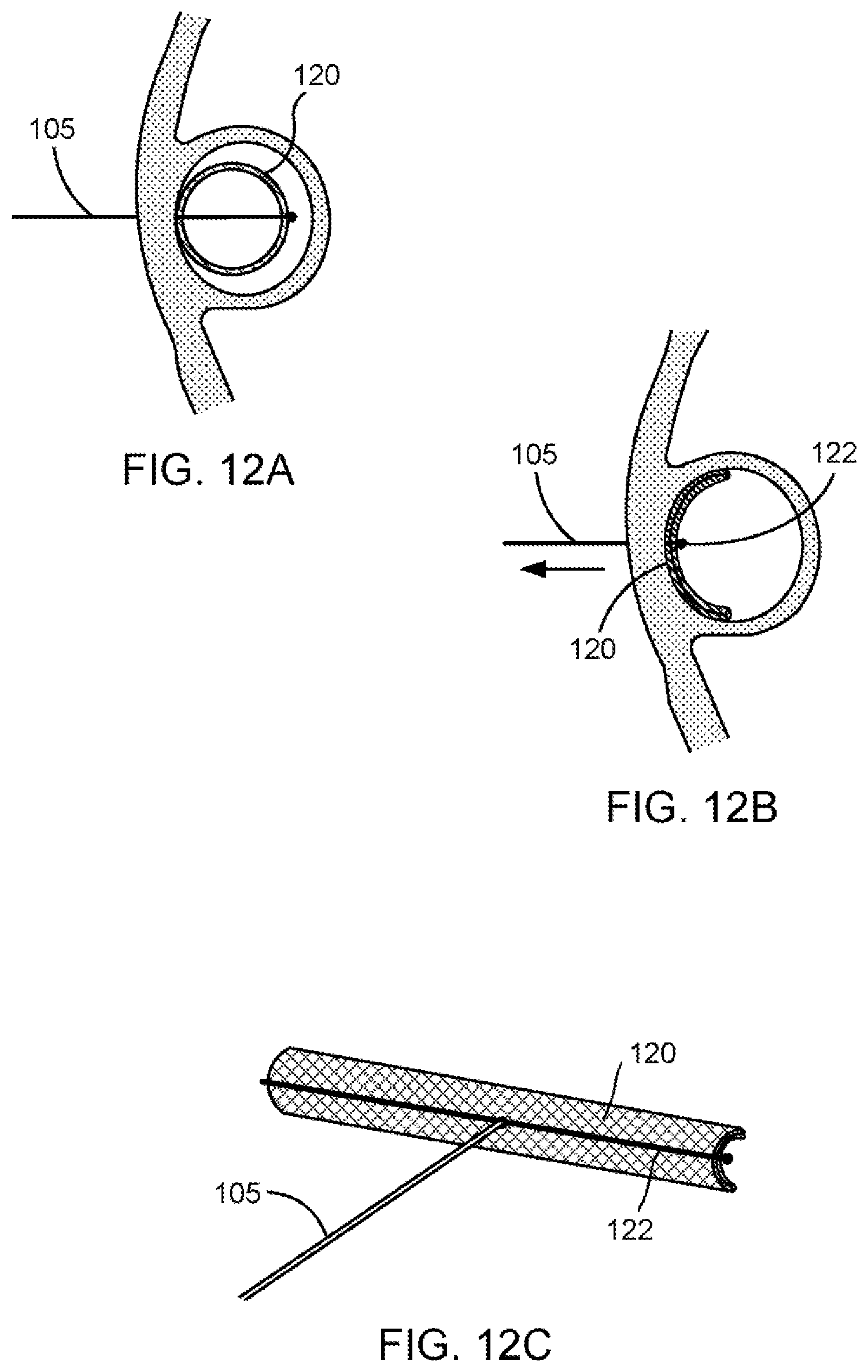 Patent US11793639 Figure 10 – Devices, systems and methods for reshaping a heart valve annulus