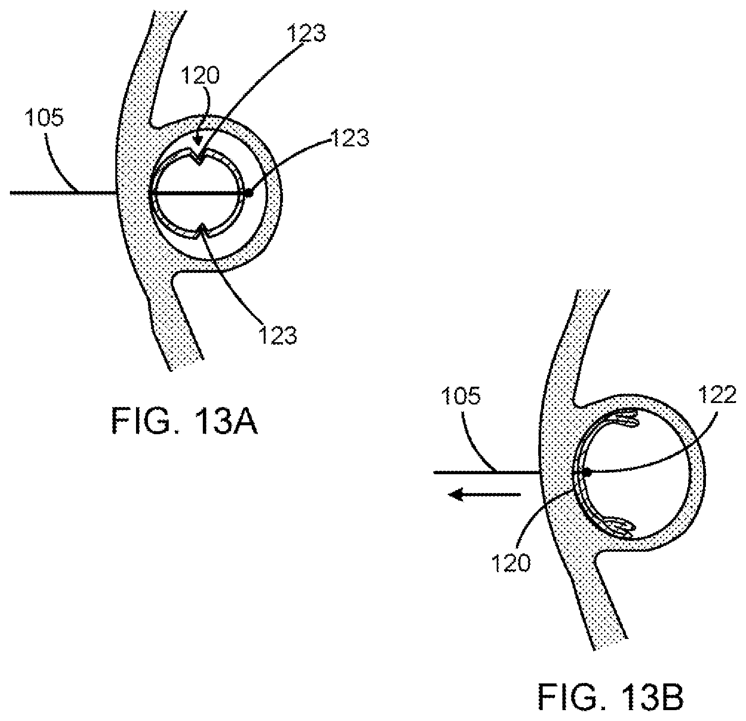 Patent US11793639 Figure 11 – Devices, systems and methods for reshaping a heart valve annulus