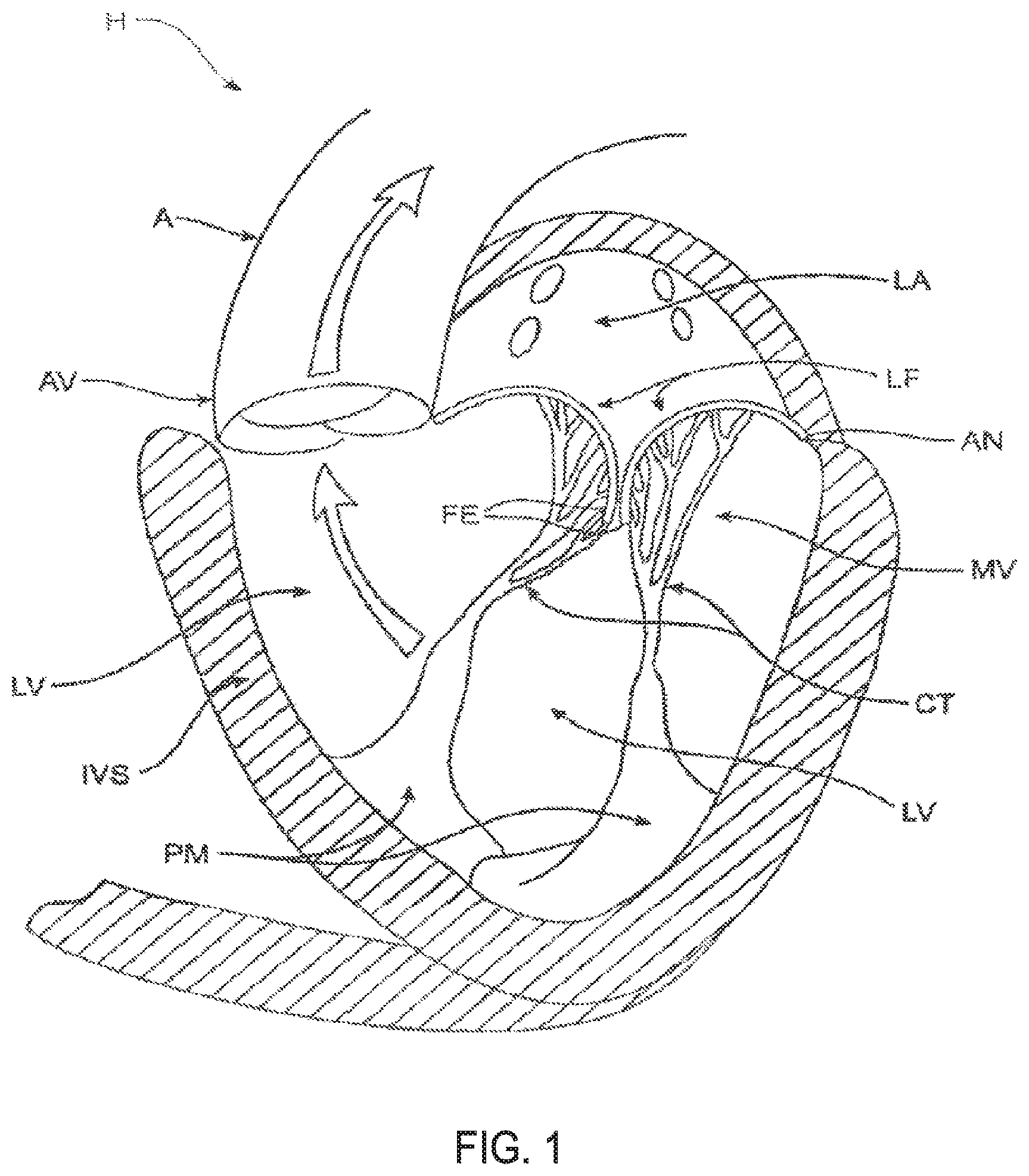 Patent US11793640 Figure 1 – Sequentially deployed transcatheter mitral valve prosthesis