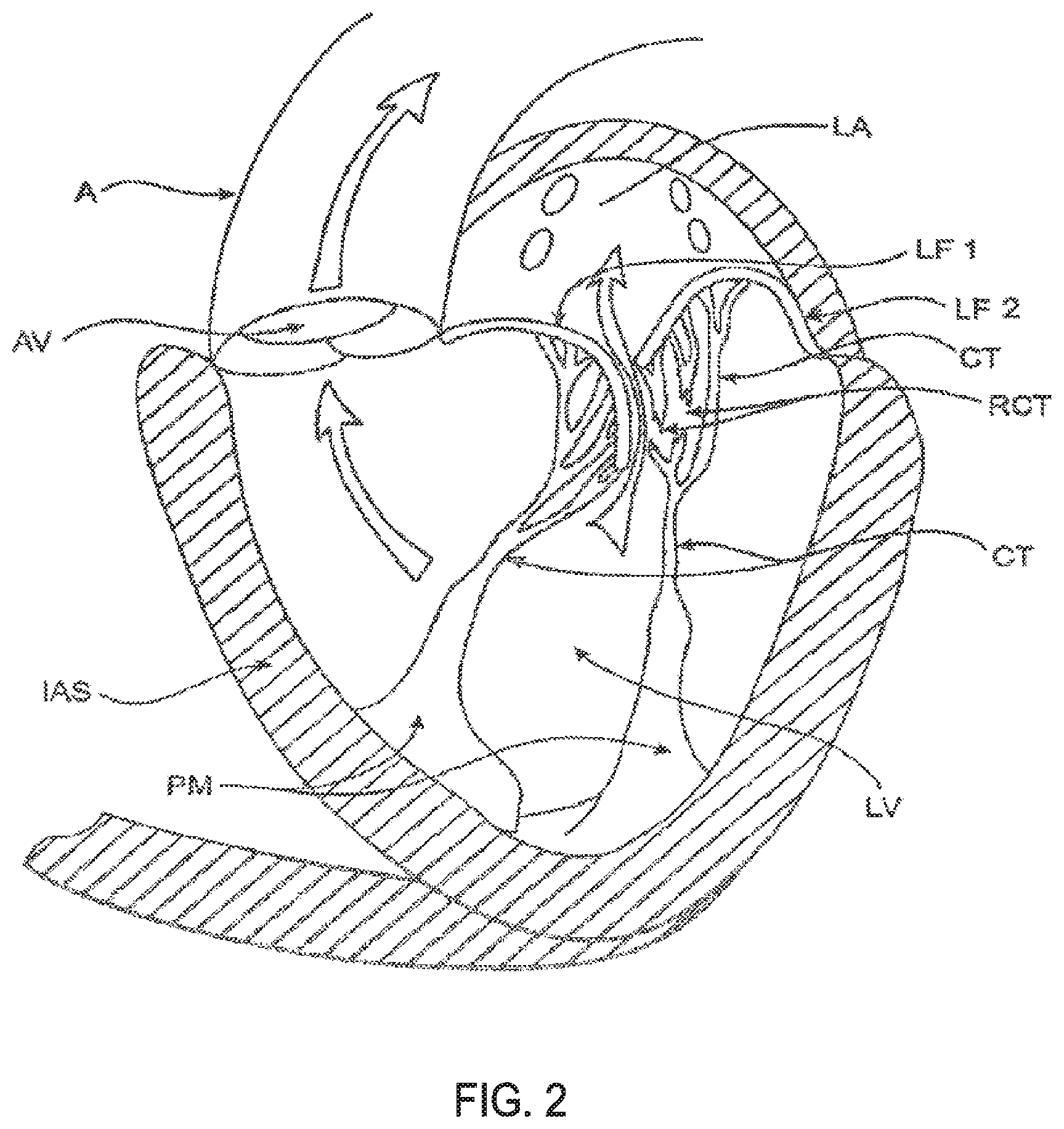 Patent US11793640 Figure 2 – Sequentially deployed transcatheter mitral valve prosthesis