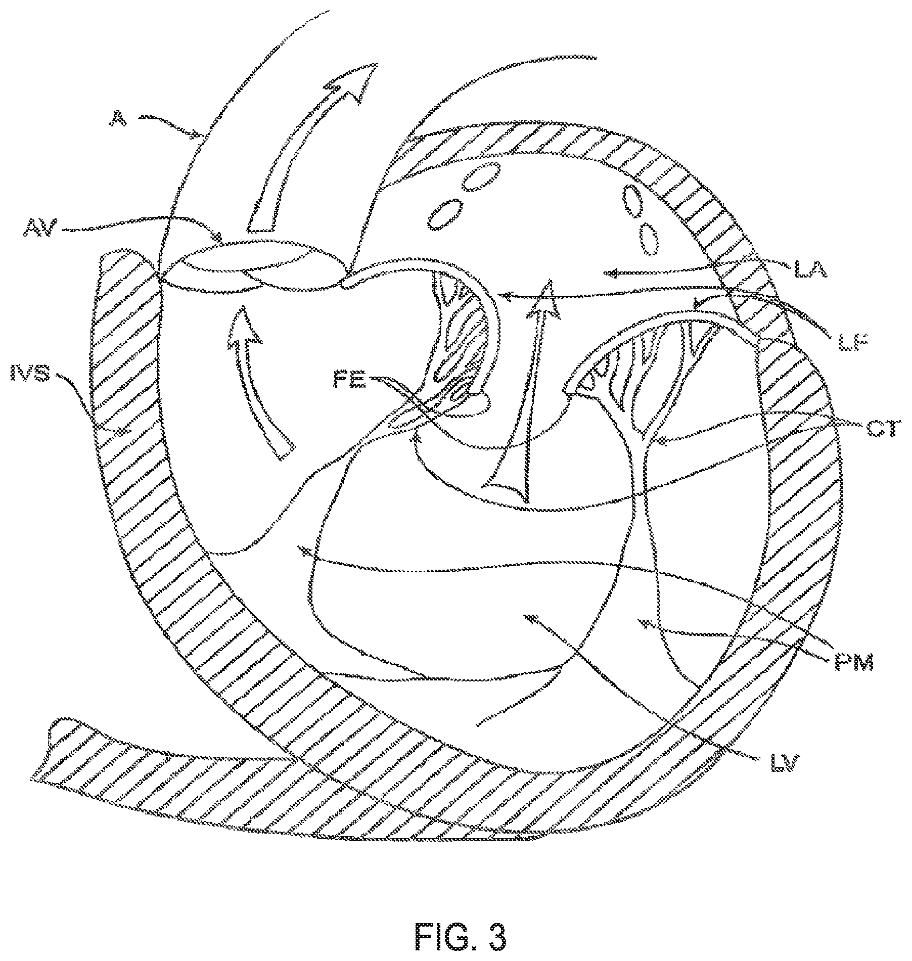 Patent US11793640 Figure 3 – Sequentially deployed transcatheter mitral valve prosthesis
