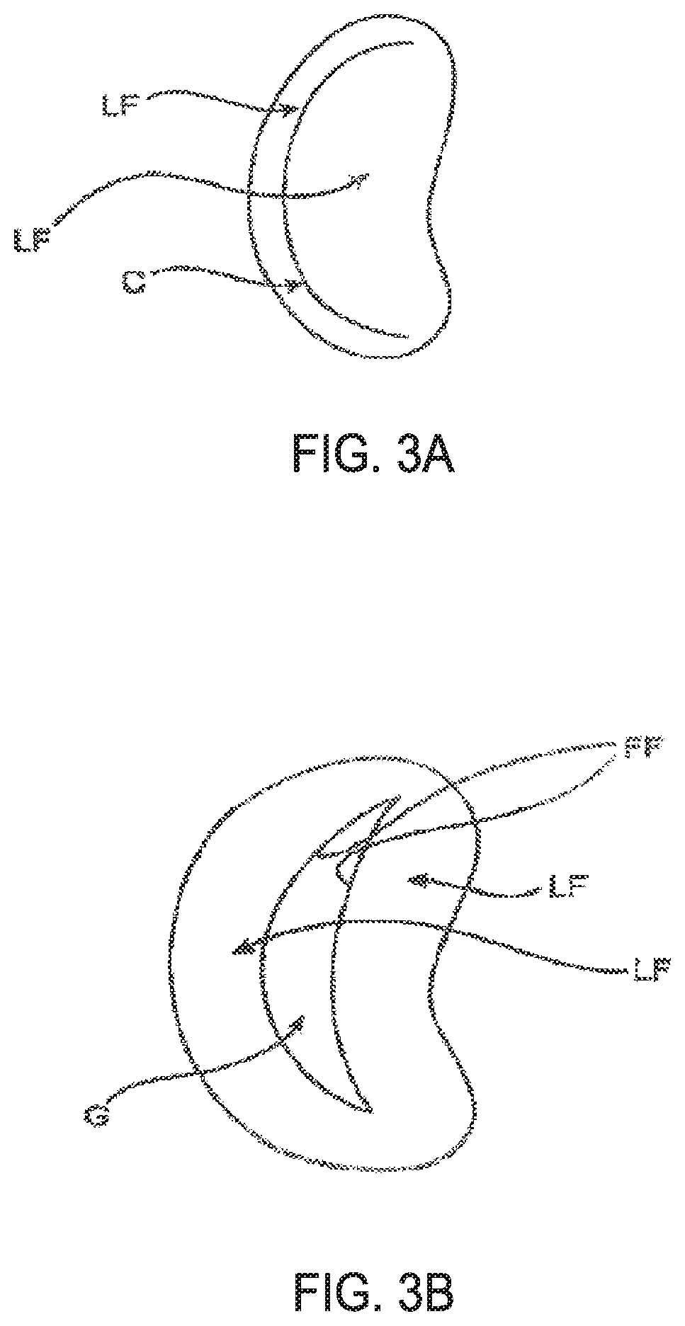 Patent US11793640 Figure 4 – Sequentially deployed transcatheter mitral valve prosthesis