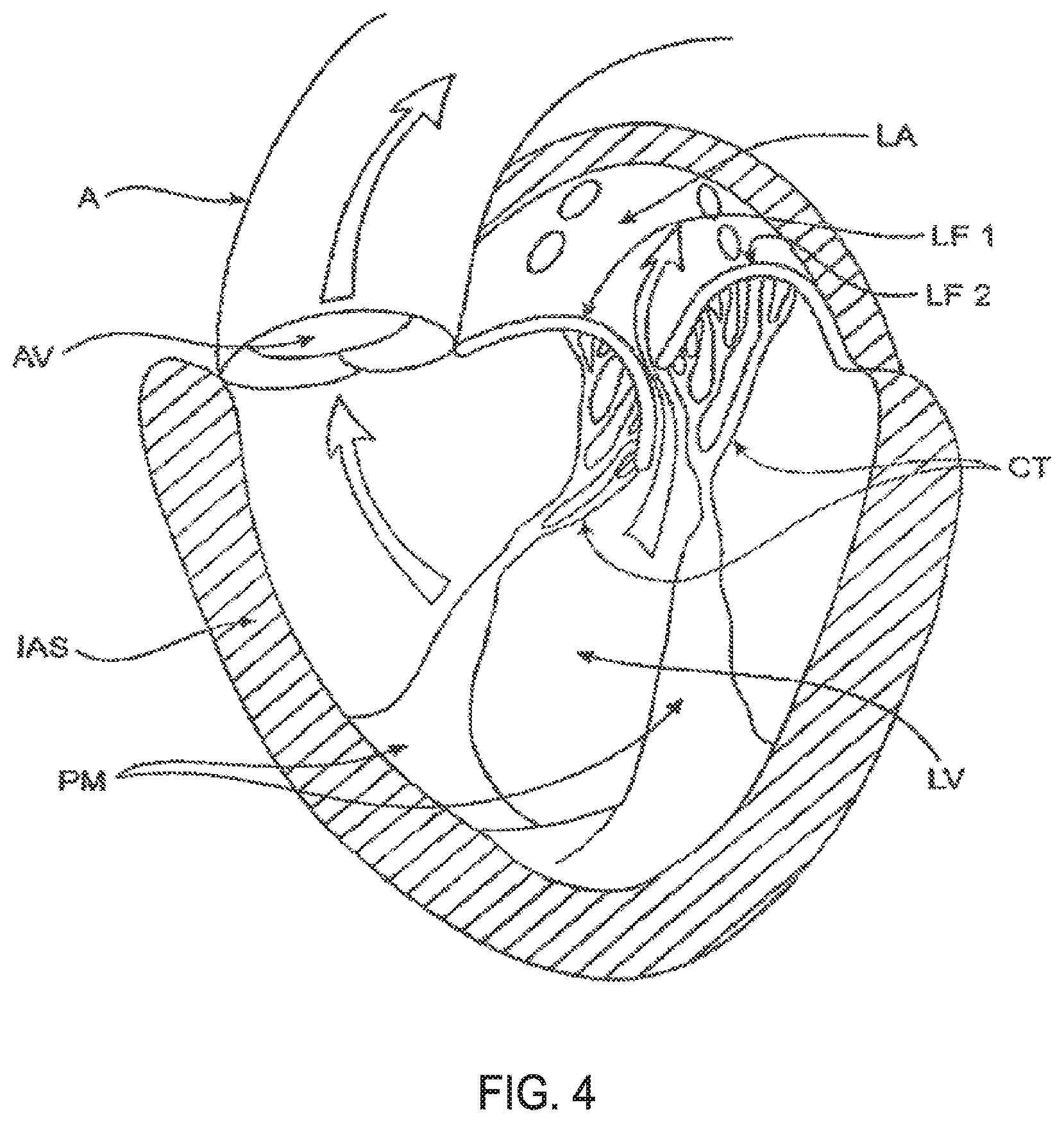 Patent US11793640 Figure 5 – Sequentially deployed transcatheter mitral valve prosthesis