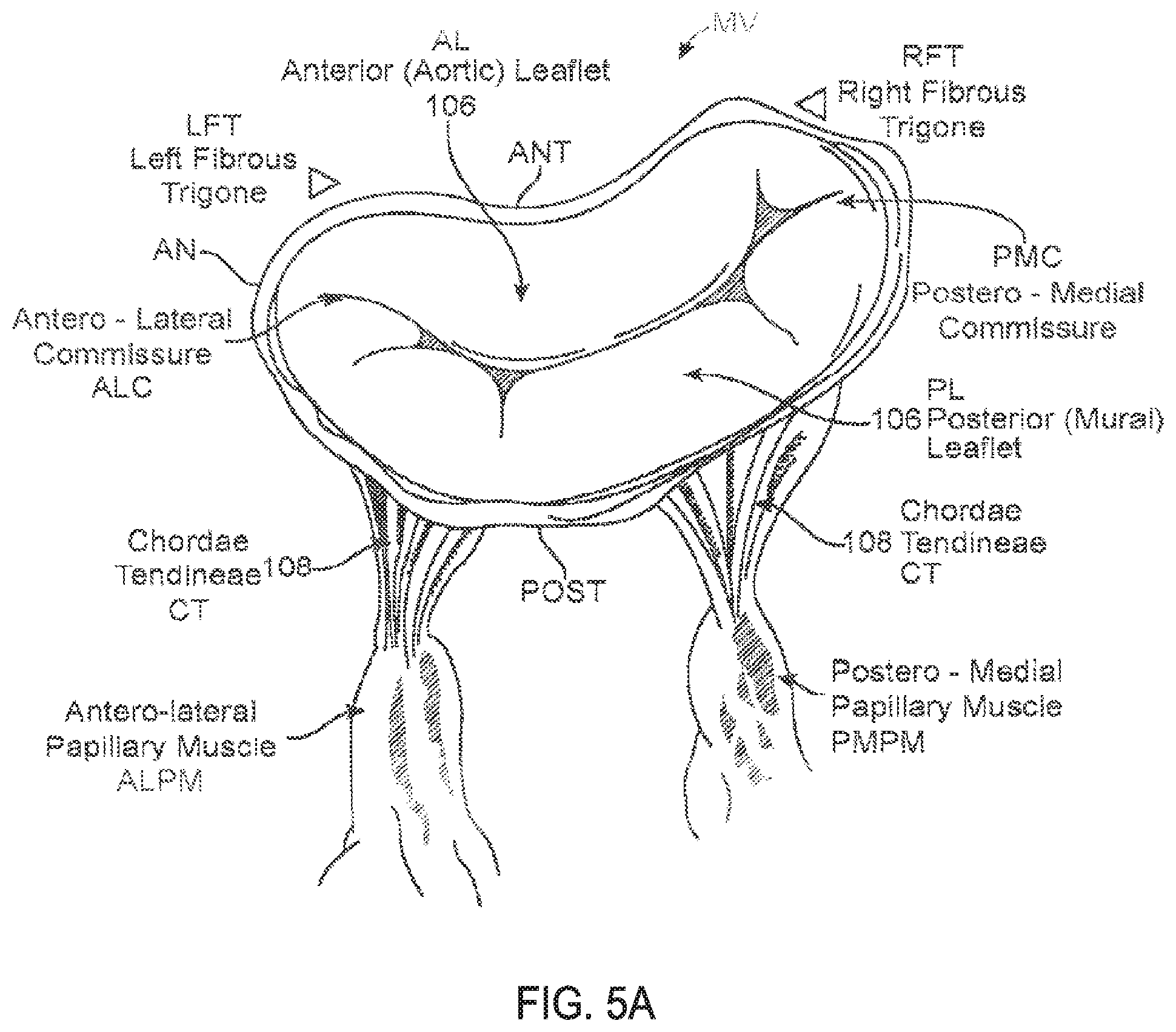 Patent US11793640 Figure 6 – Sequentially deployed transcatheter mitral valve prosthesis
