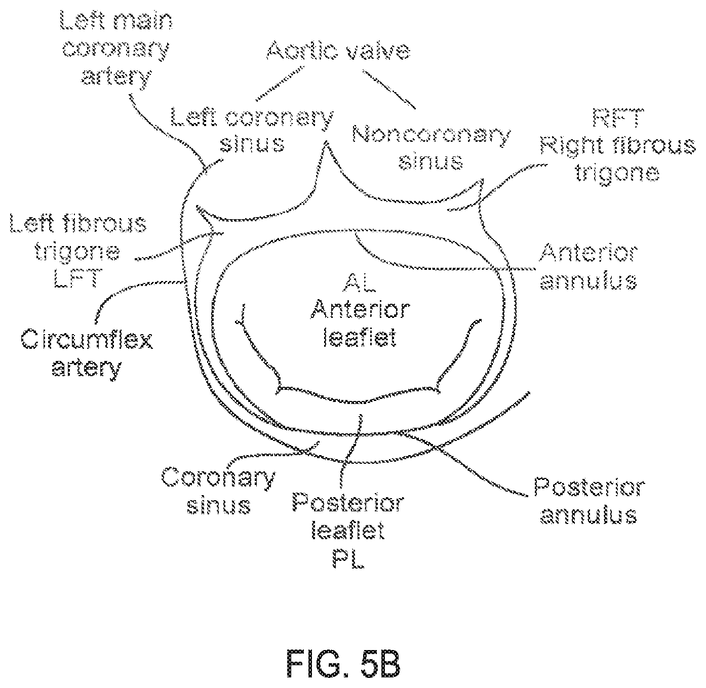 Patent US11793640 Figure 7 – Sequentially deployed transcatheter mitral valve prosthesis