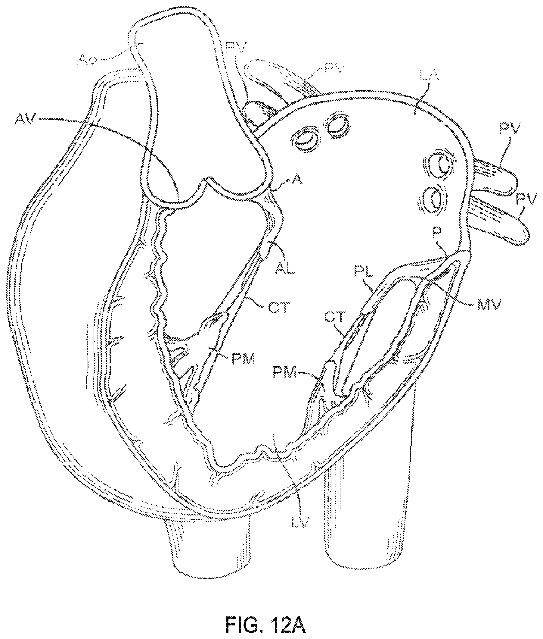Patent US11793640 Figure 18 – Sequentially deployed transcatheter mitral valve prosthesis