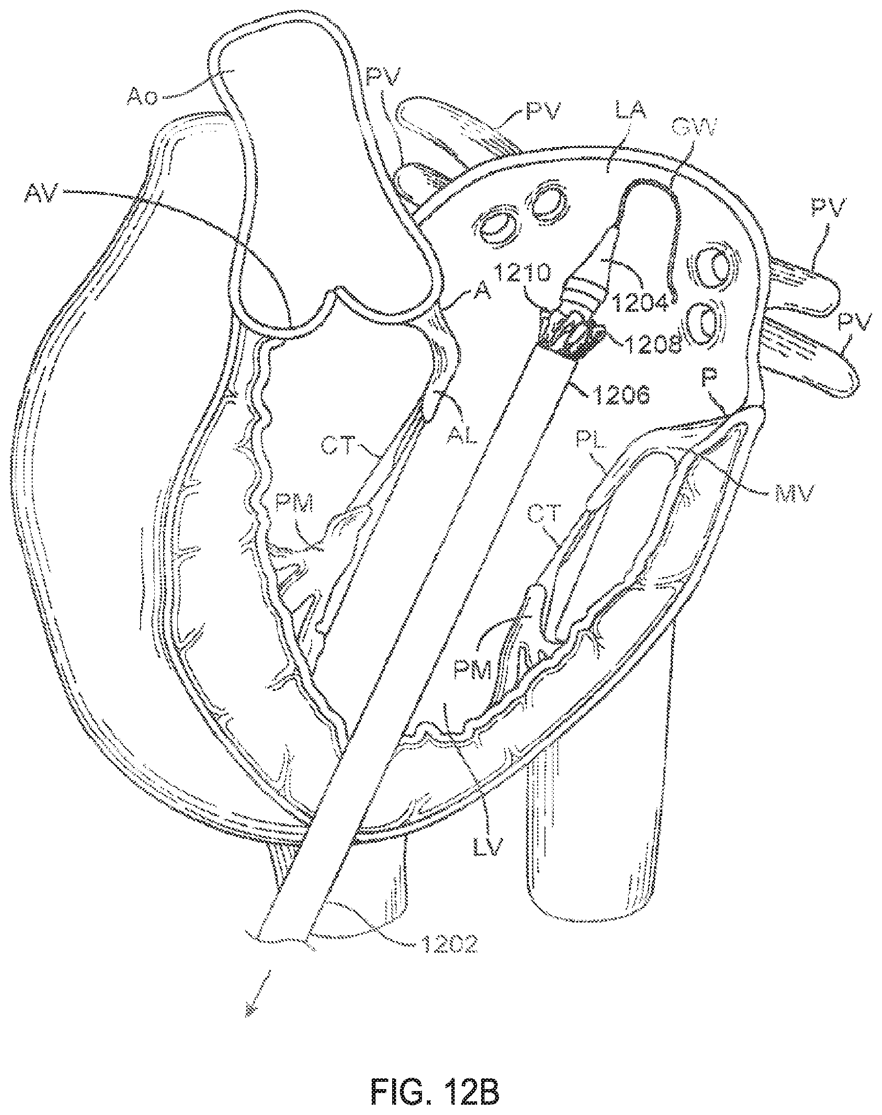 Patent US11793640 Figure 19 – Sequentially deployed transcatheter mitral valve prosthesis