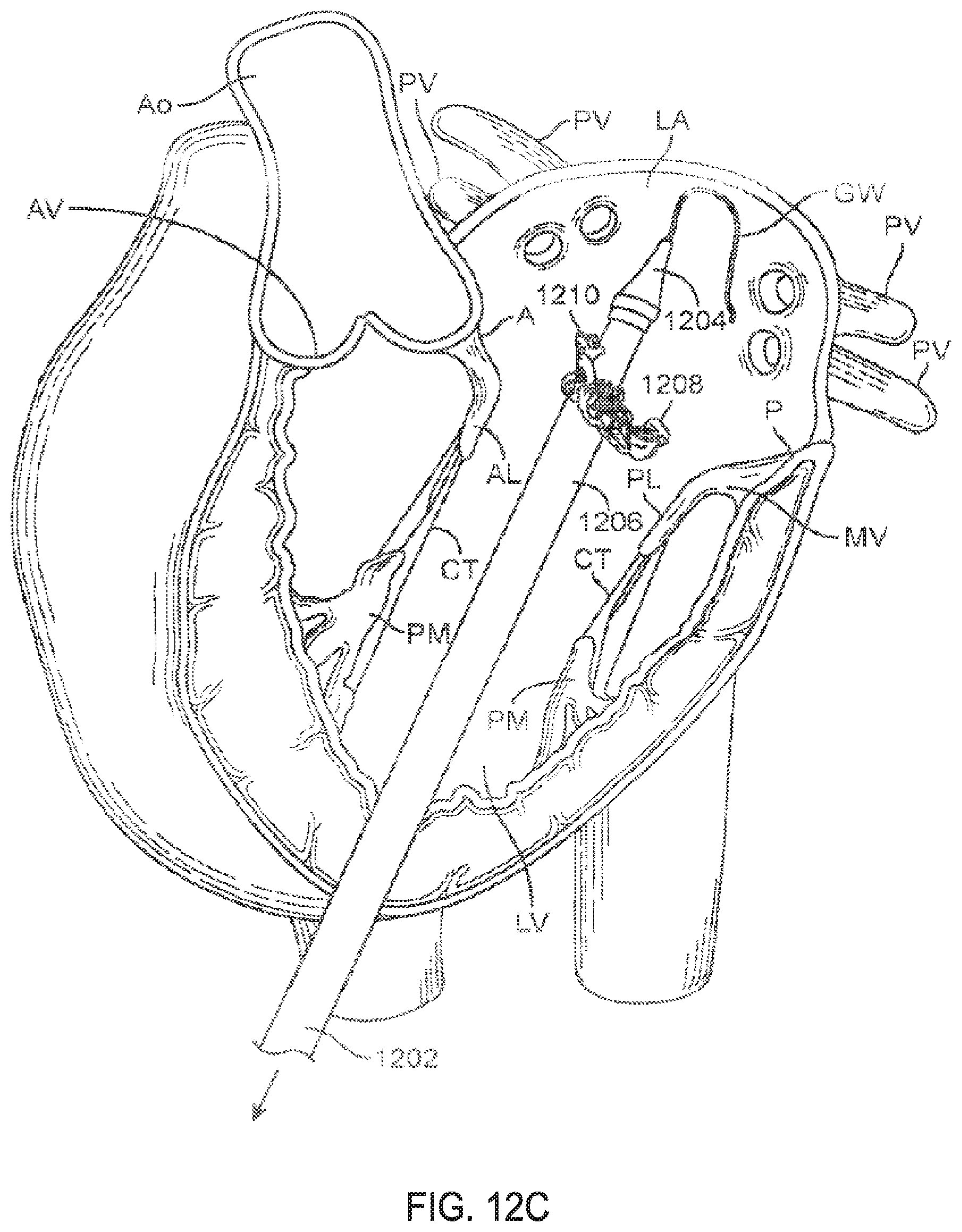 Patent US11793640 Figure 20 – Sequentially deployed transcatheter mitral valve prosthesis